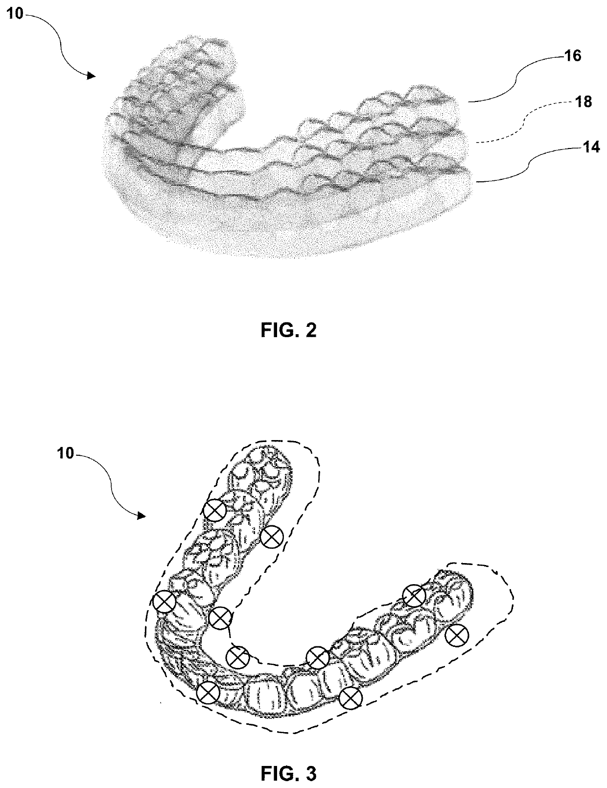 Elastically modifiable orthodontic appliances