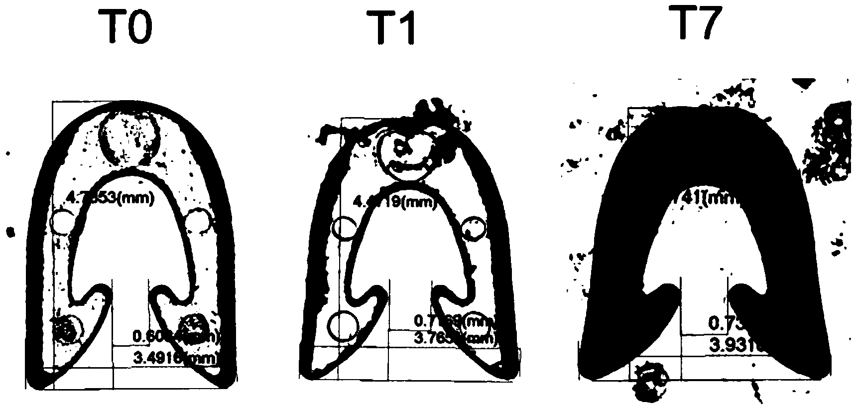 Absorbable skin suturing nail and preparation method thereof