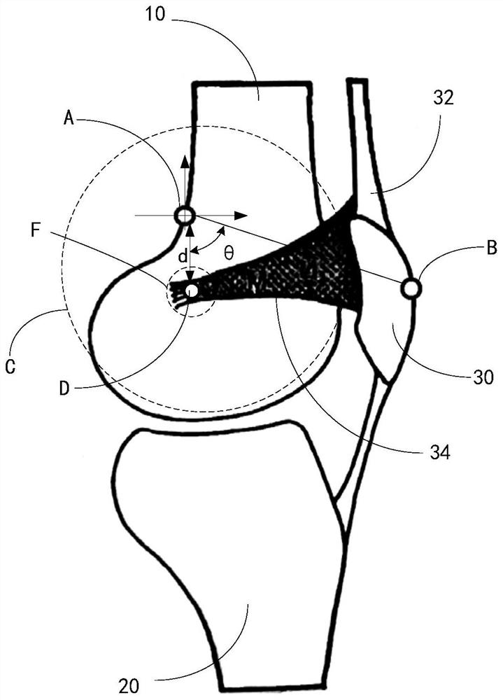 A method for positioning the anatomical insertion point of the medial patellar ligament