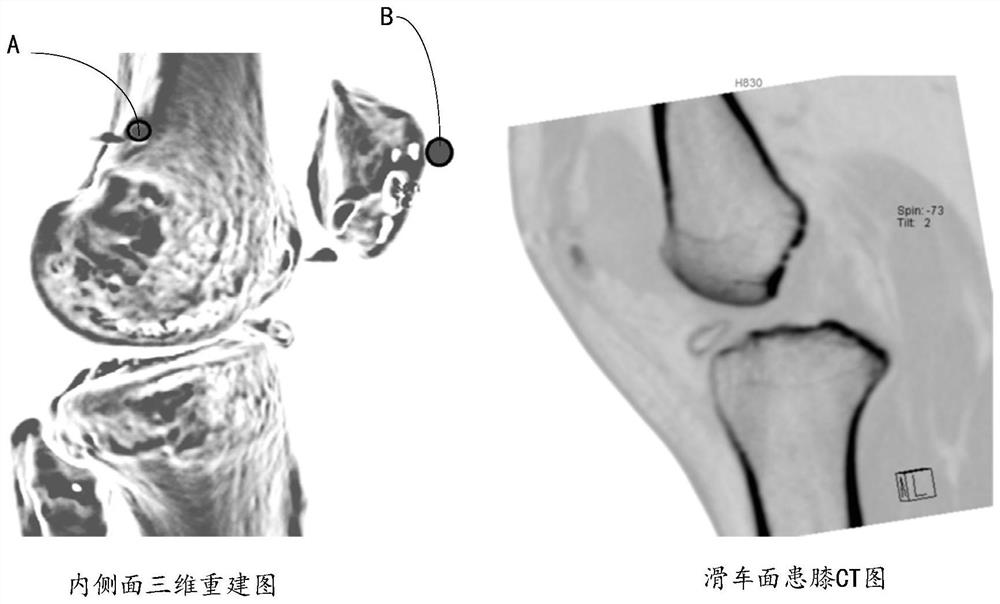 A method for positioning the anatomical insertion point of the medial patellar ligament