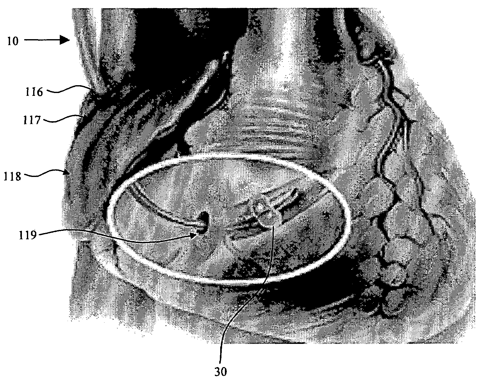 Ablative treatment of atrial fibrillation via the coronary sinus