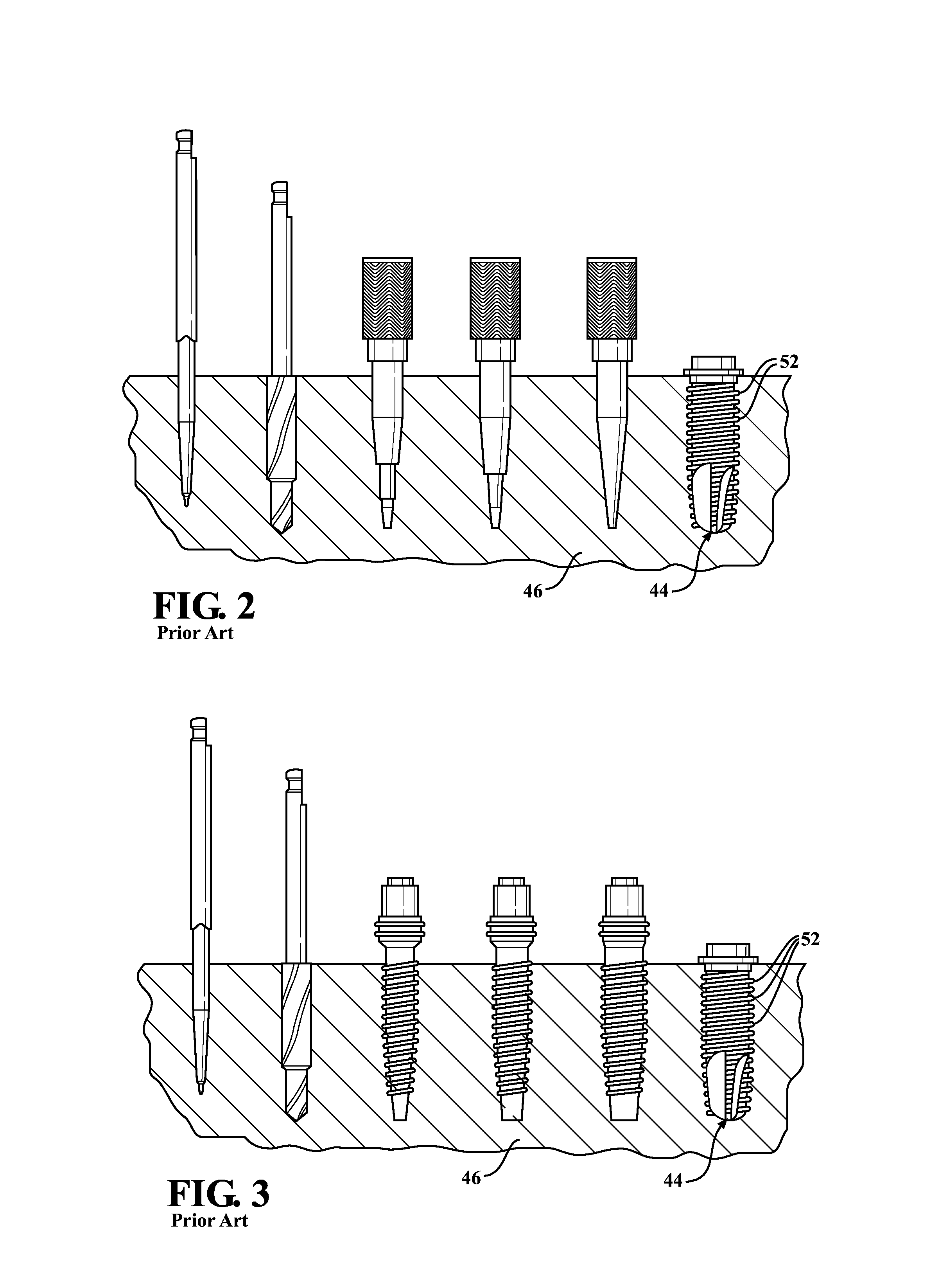 Fluted osteotome and surgical method for use