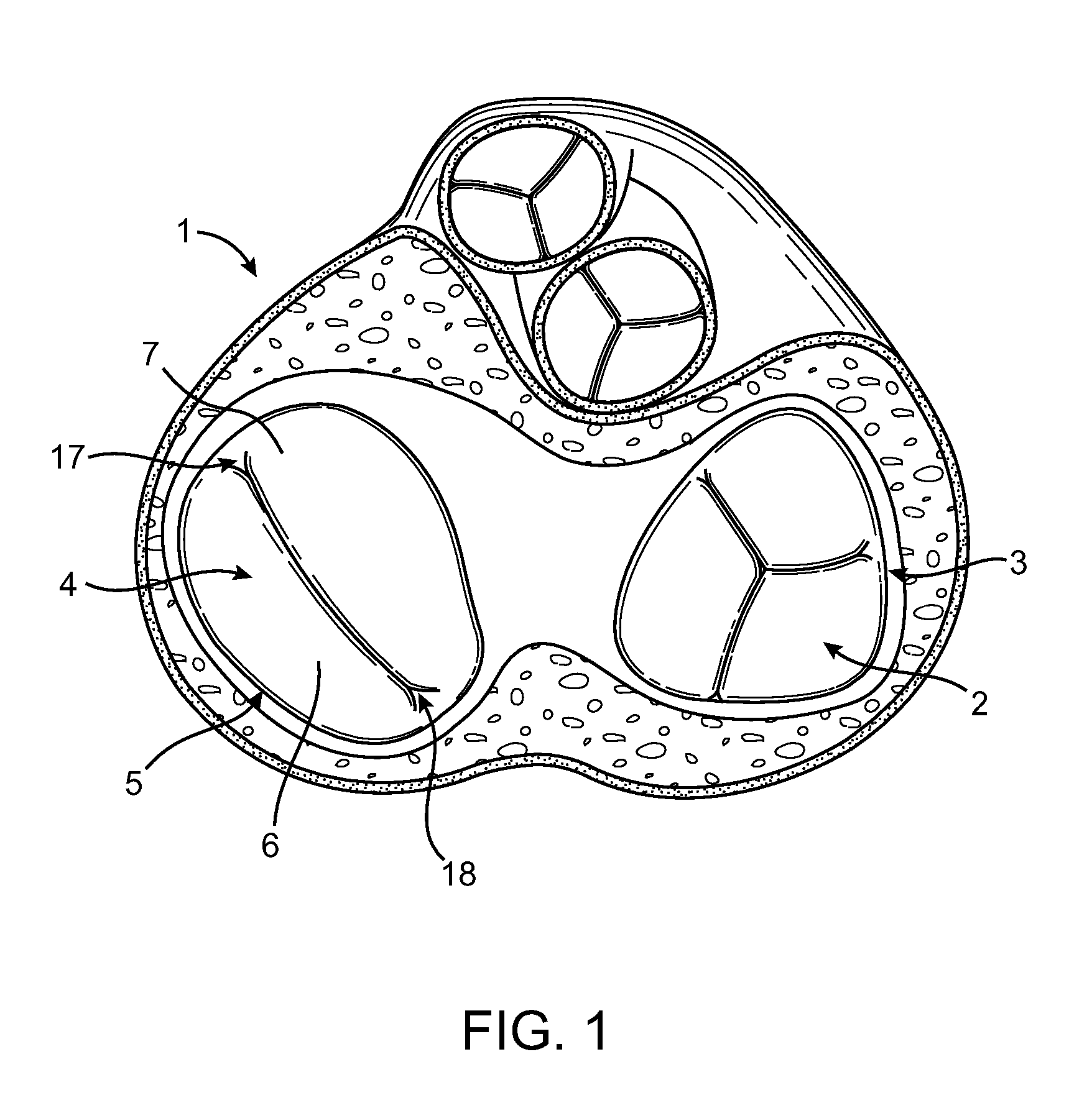 Minimally invasive procedure for implanting an annuloplasty device