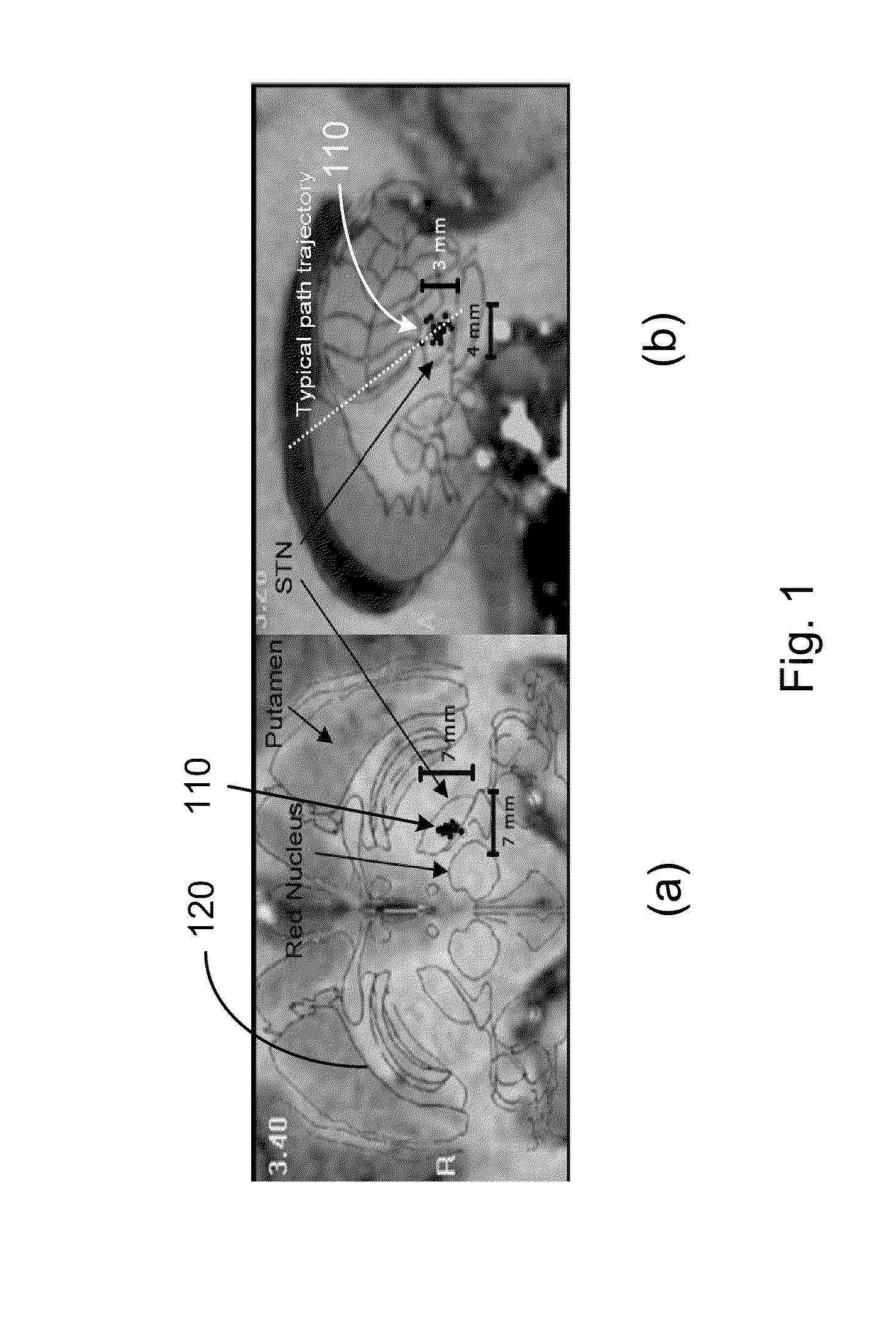 System and methods of deep brain stimulation for post-operation patients