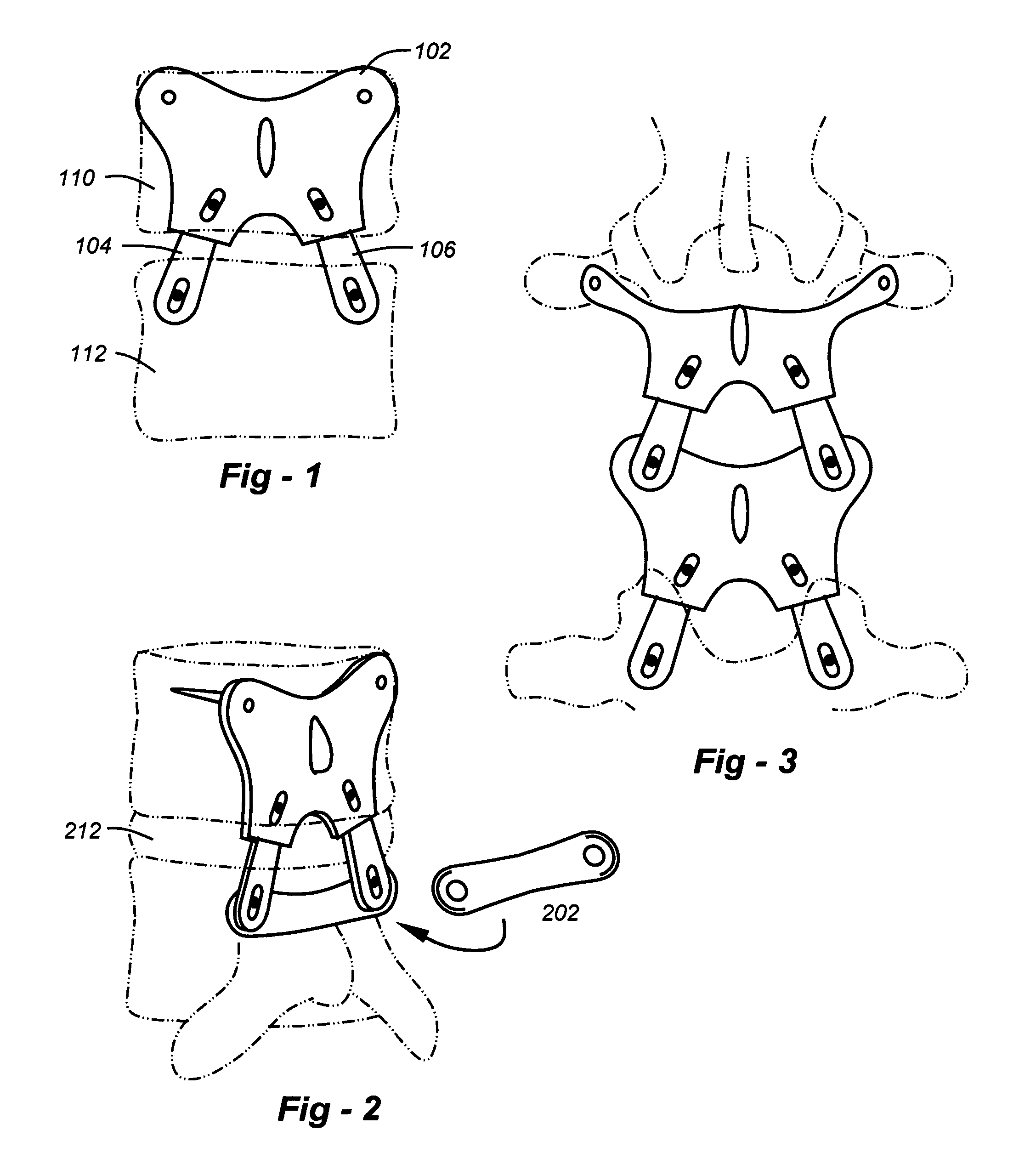 Posterior spinal reconstruction system