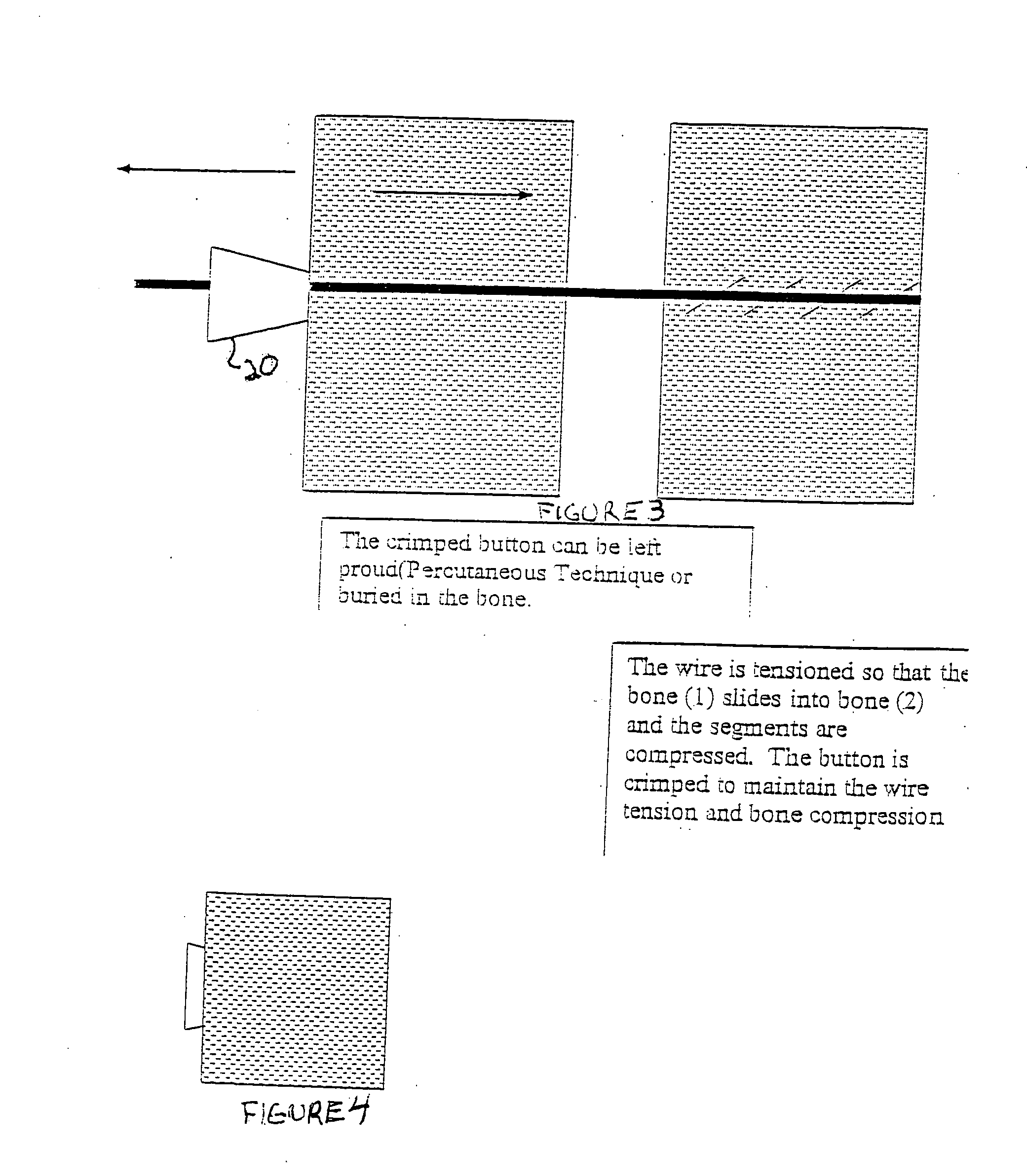 Method and device for bone stabilization using a threaded compression wire