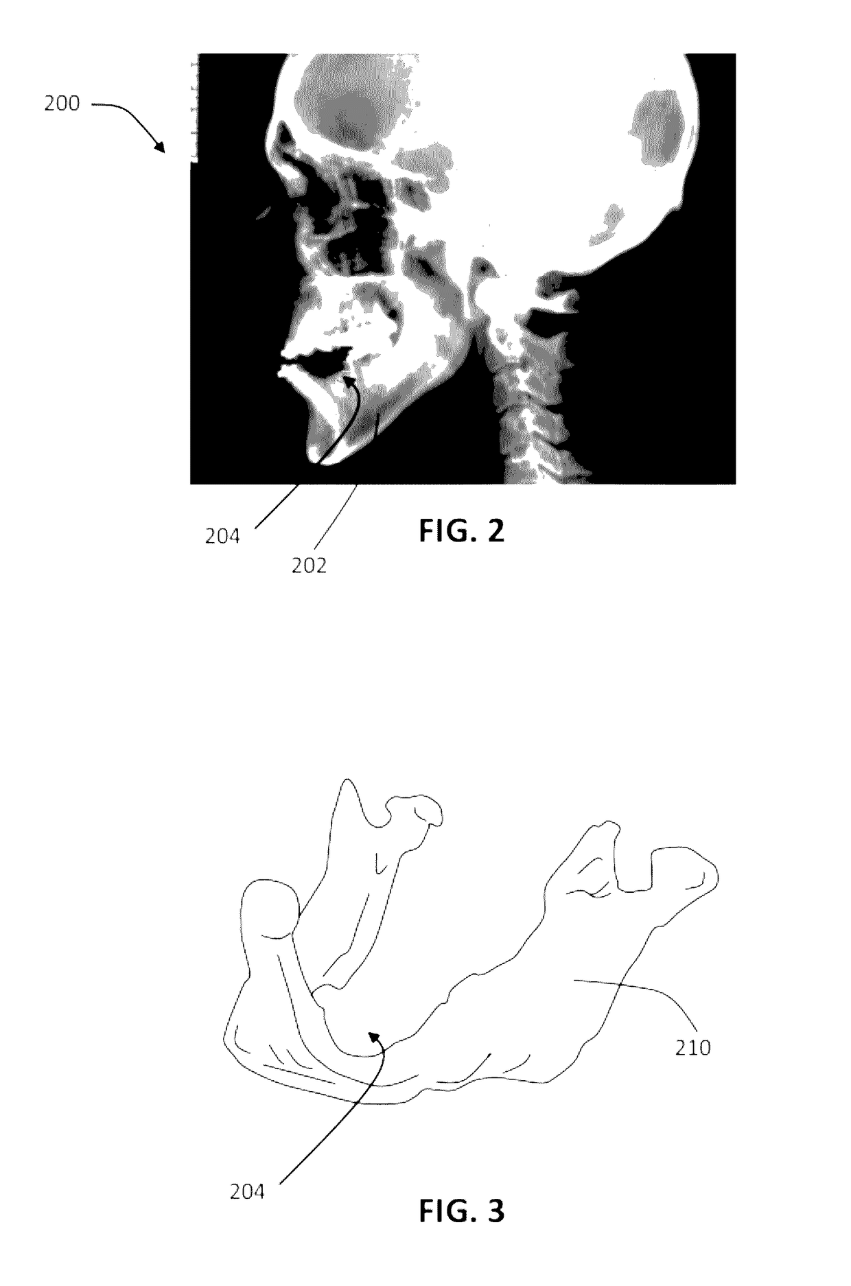 Patient-specific manufacturing of porous metal prostheses