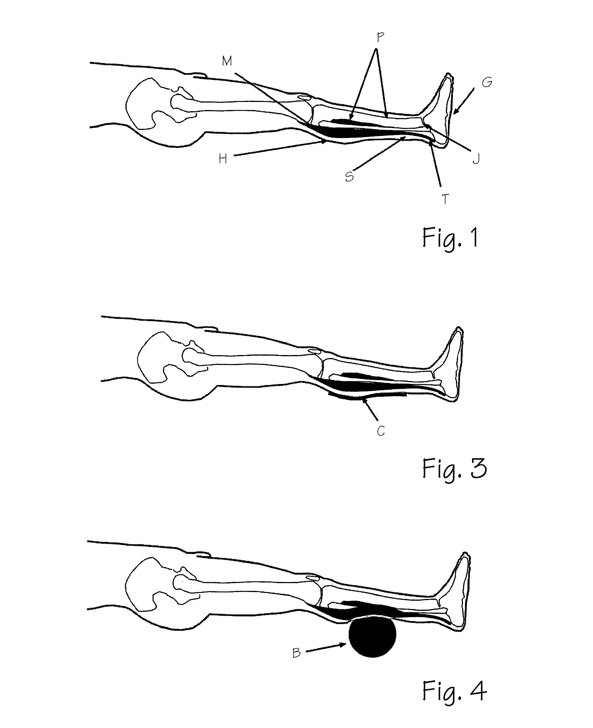 Devices and methods for treating restless leg syndrome