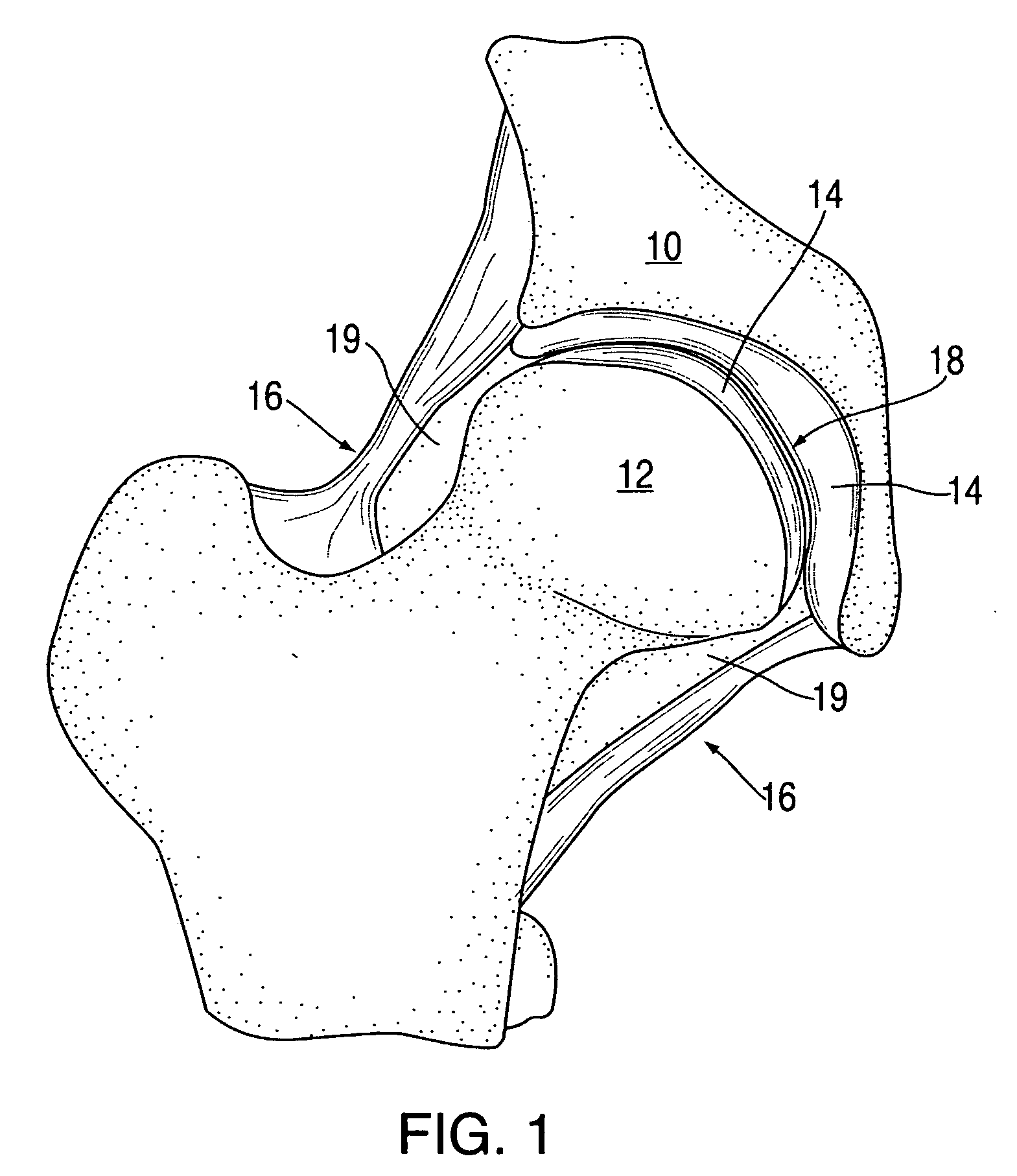 Device & method for restoring joints with artificial cartilage