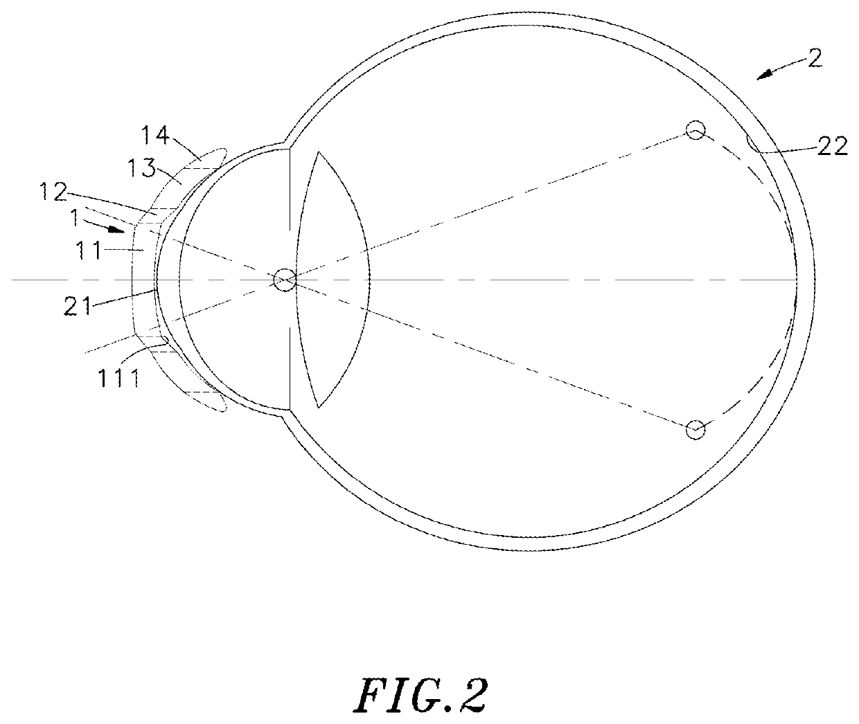Design structure of reverse curve of orthokeratology lens