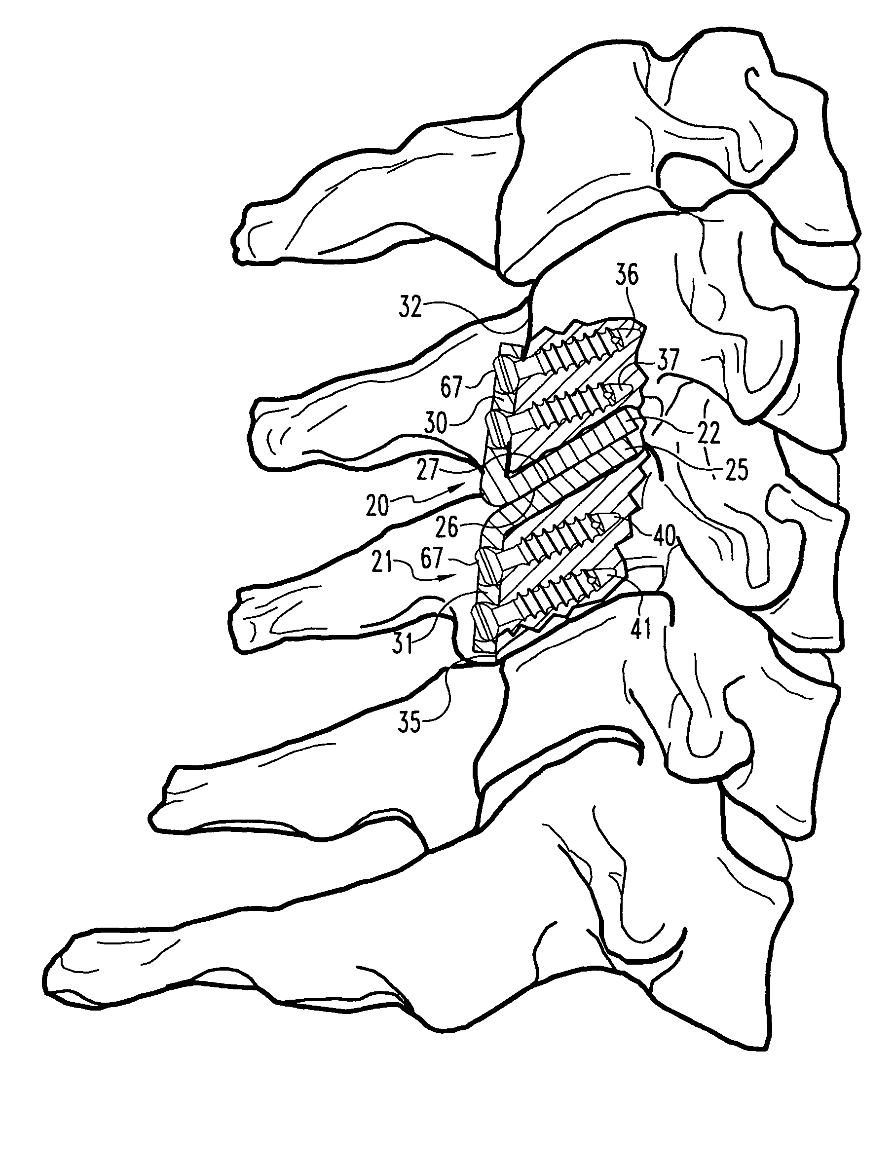 Replacement facet joint and method