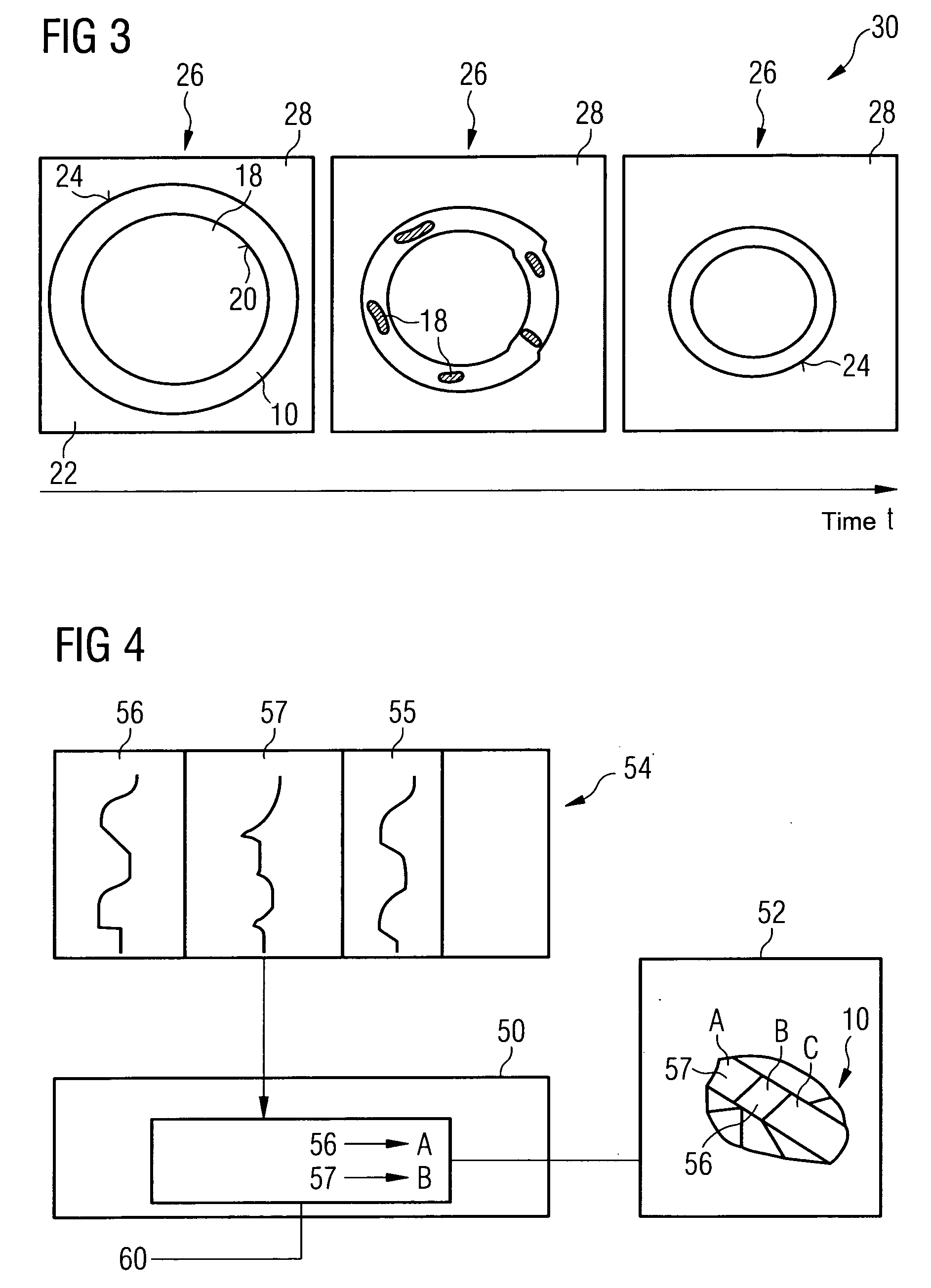 Method for segmenting a myocardial wall and device for detecting a coronary artery with pathological changes