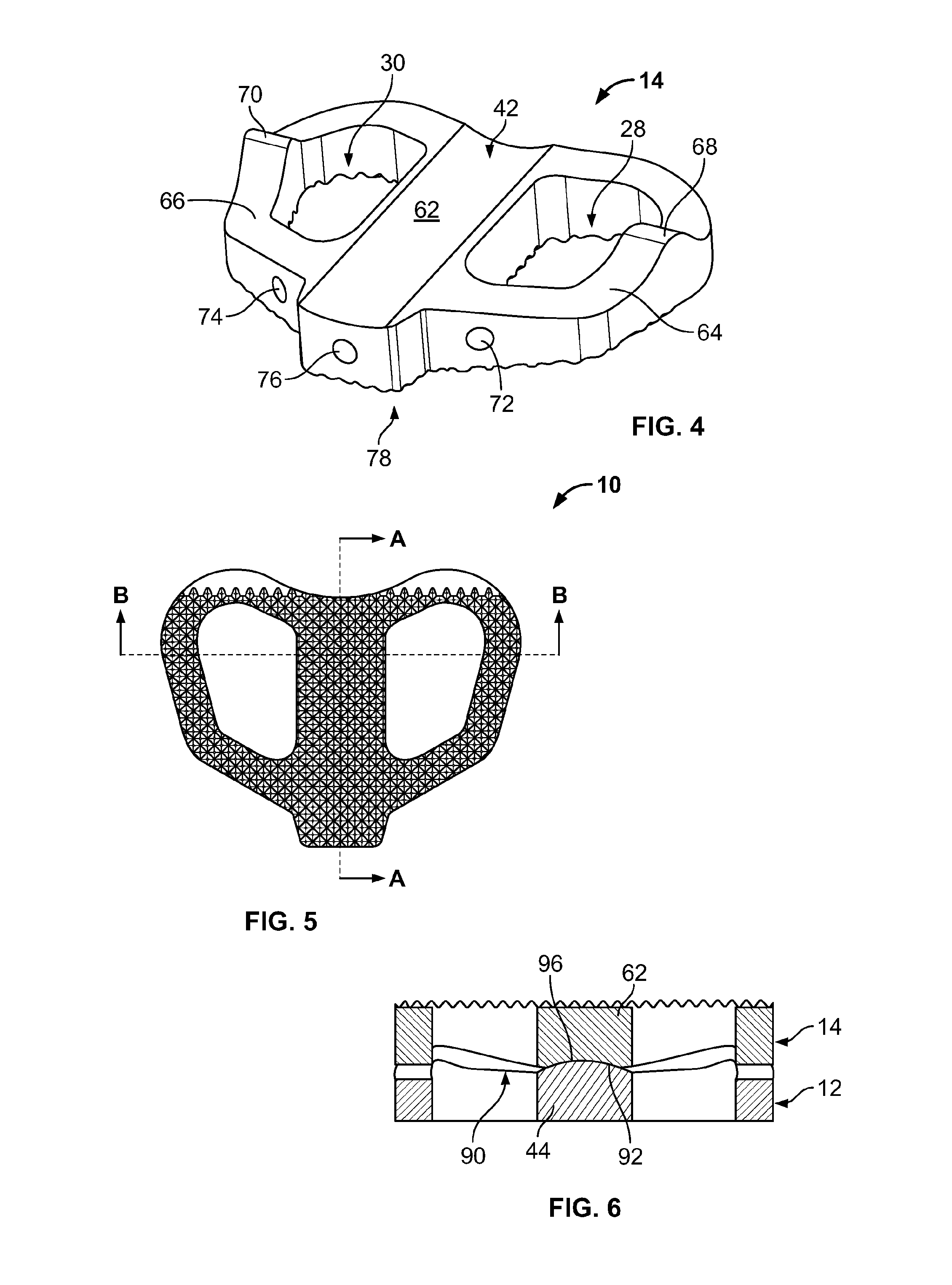 Spinal implant, instrument for preparation and method of use