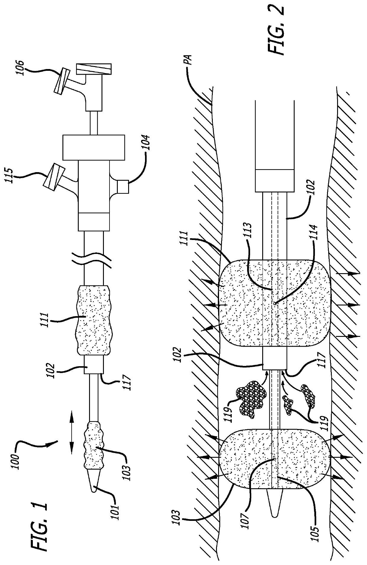 Pulmonary Embolism Removal System