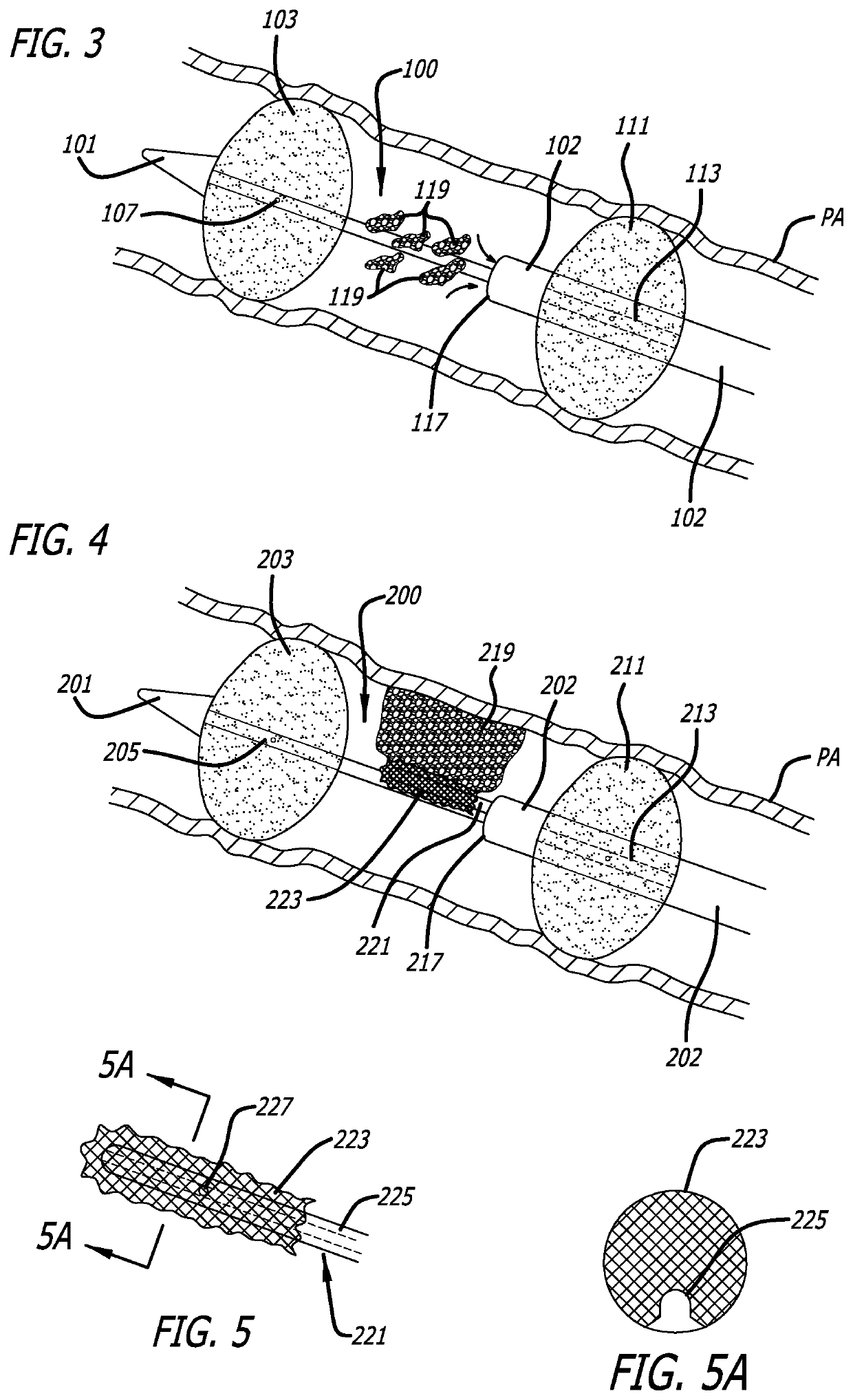 Pulmonary Embolism Removal System