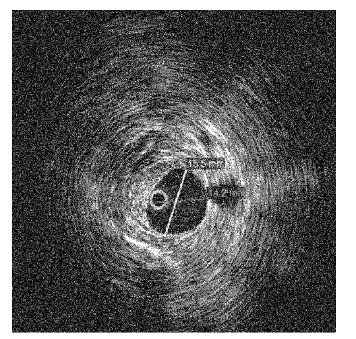 Method for Diagnosing and Treating Hemorrhoids