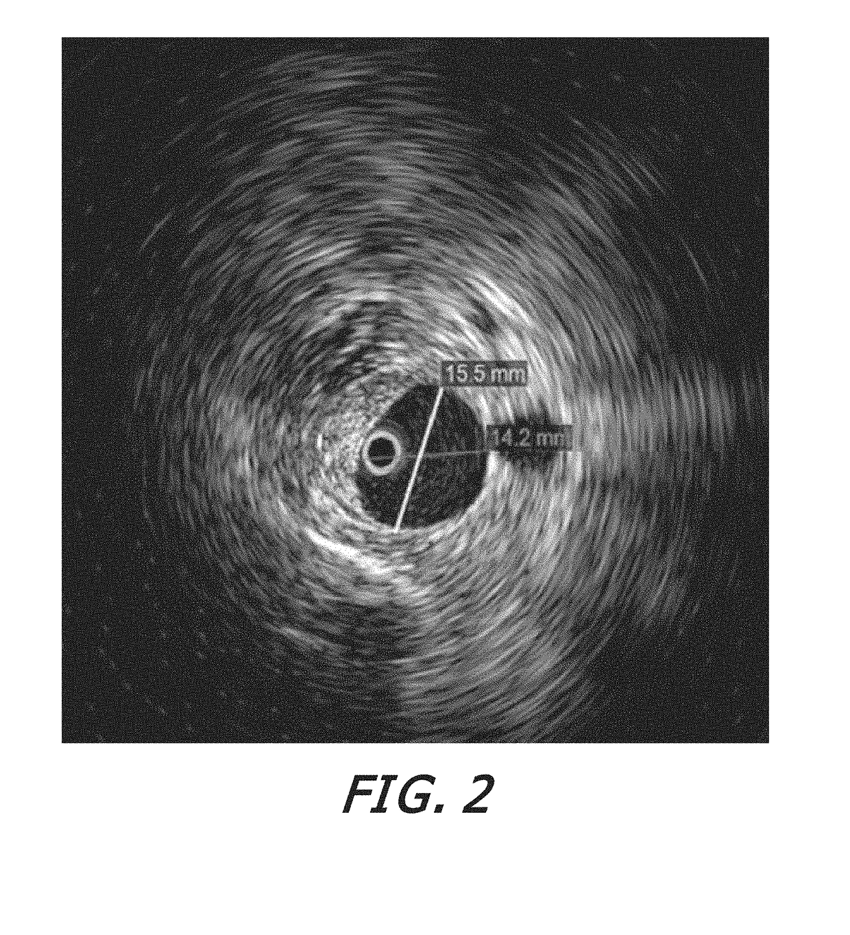 Method for Diagnosing and Treating Hemorrhoids