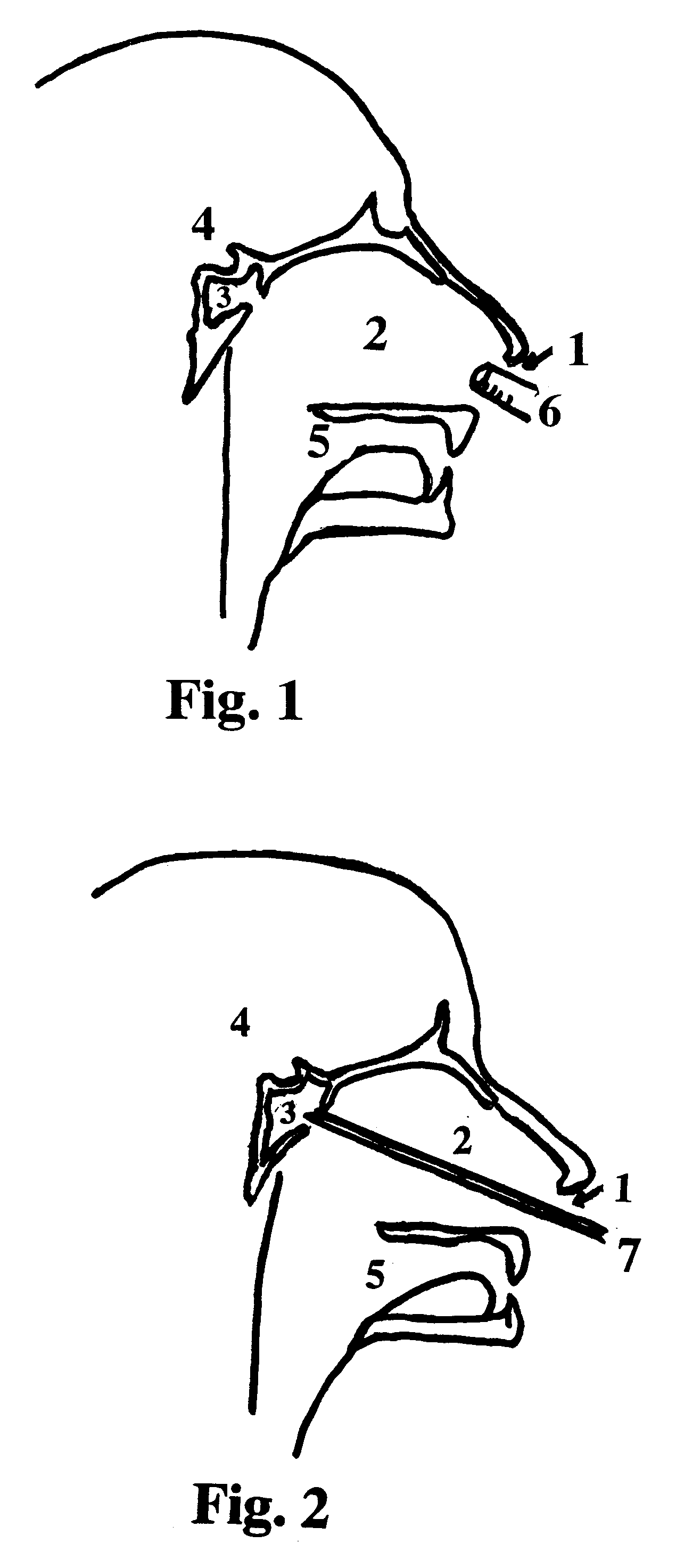 Method for inducing hypothermia for treating neurological disorders