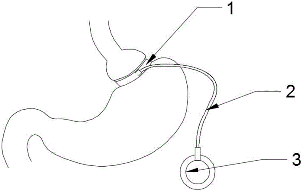 Gastric banding and gastrointestinal electrical stimulation combined device for treating obesity and application method thereof