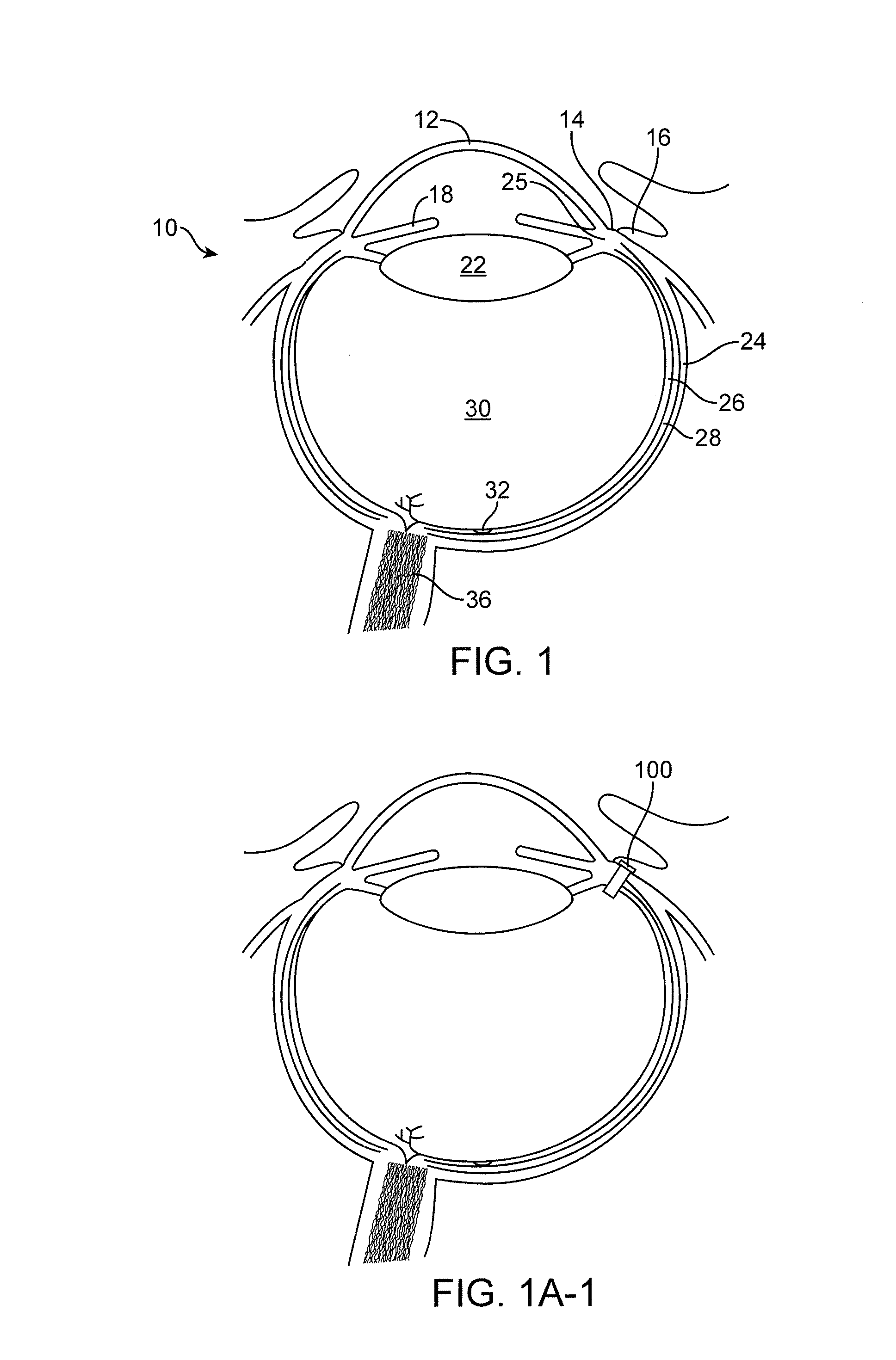 Implantable therapeutic device