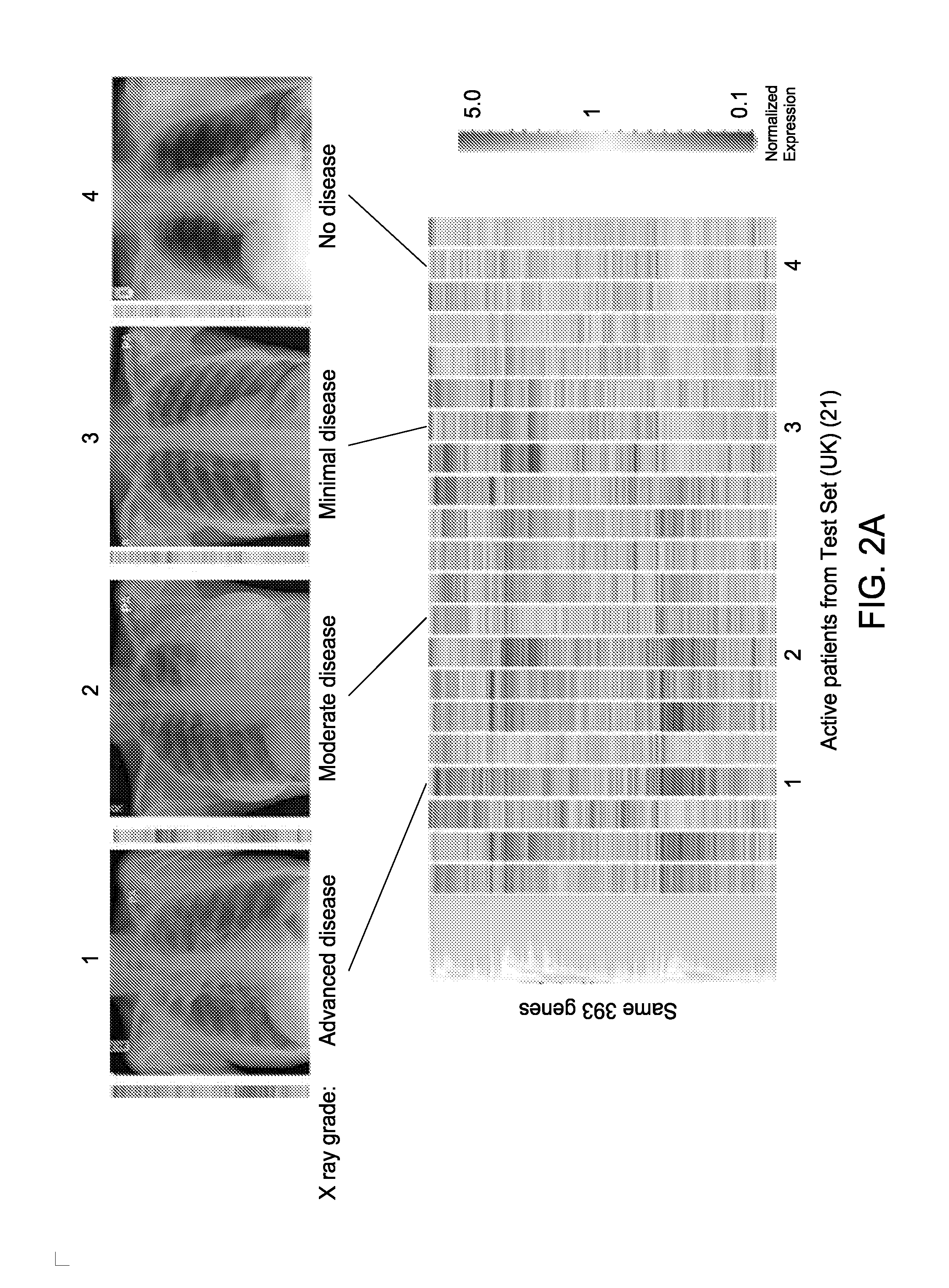 Blood transcriptional signature of active versus latent mycobacterium tuberculosis infection