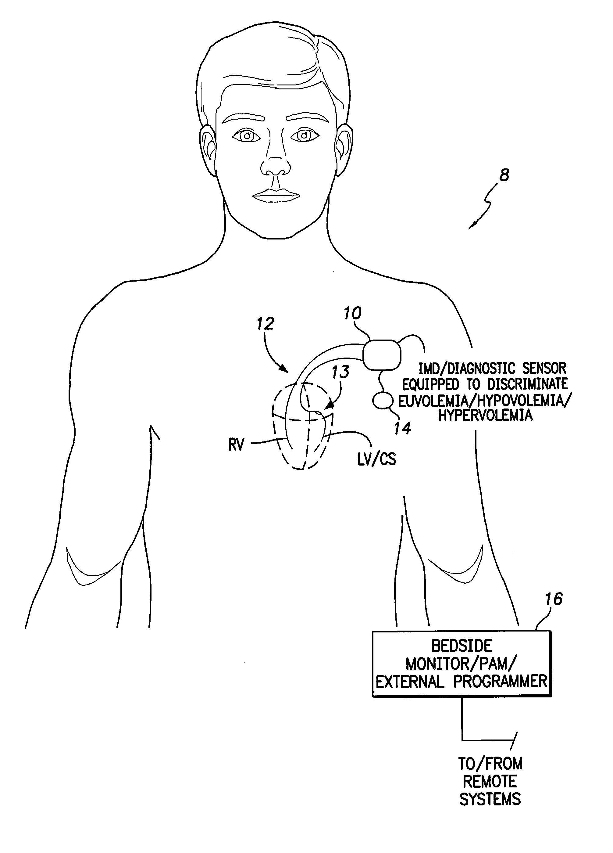 System and method for discriminating hypervolemia, hypovolemia and euvolemia using an implantable medical device