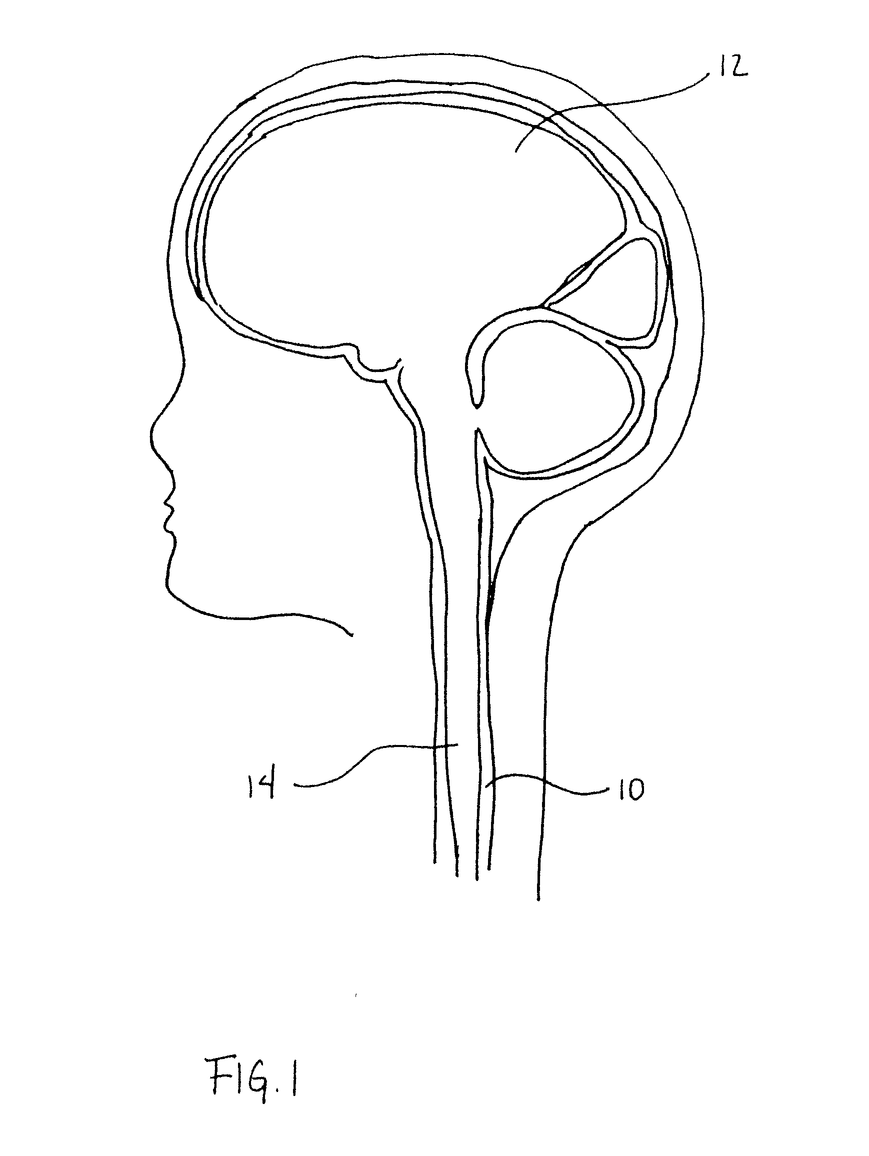 Bidirectional cerebral spinal fluid infusion catheter with cooling mechanism and method of use
