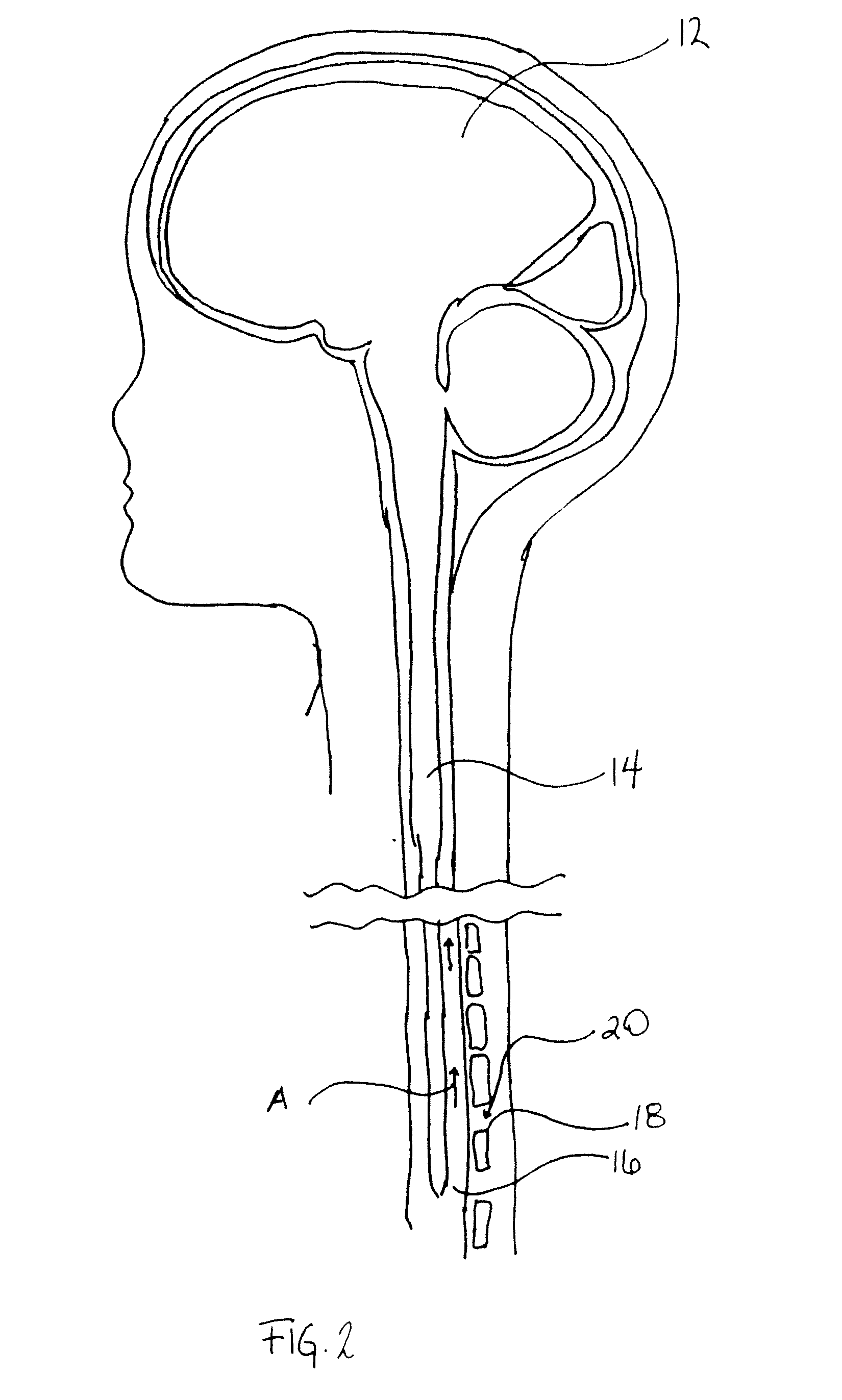 Bidirectional cerebral spinal fluid infusion catheter with cooling mechanism and method of use
