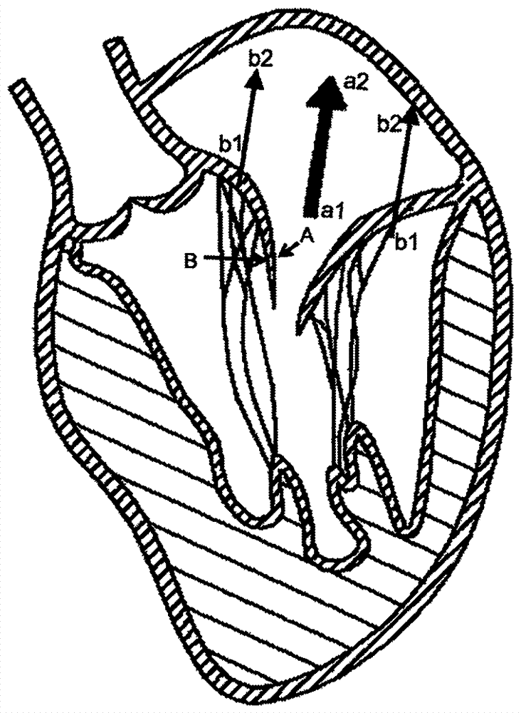 Heart valve prosthesis with clamping devices