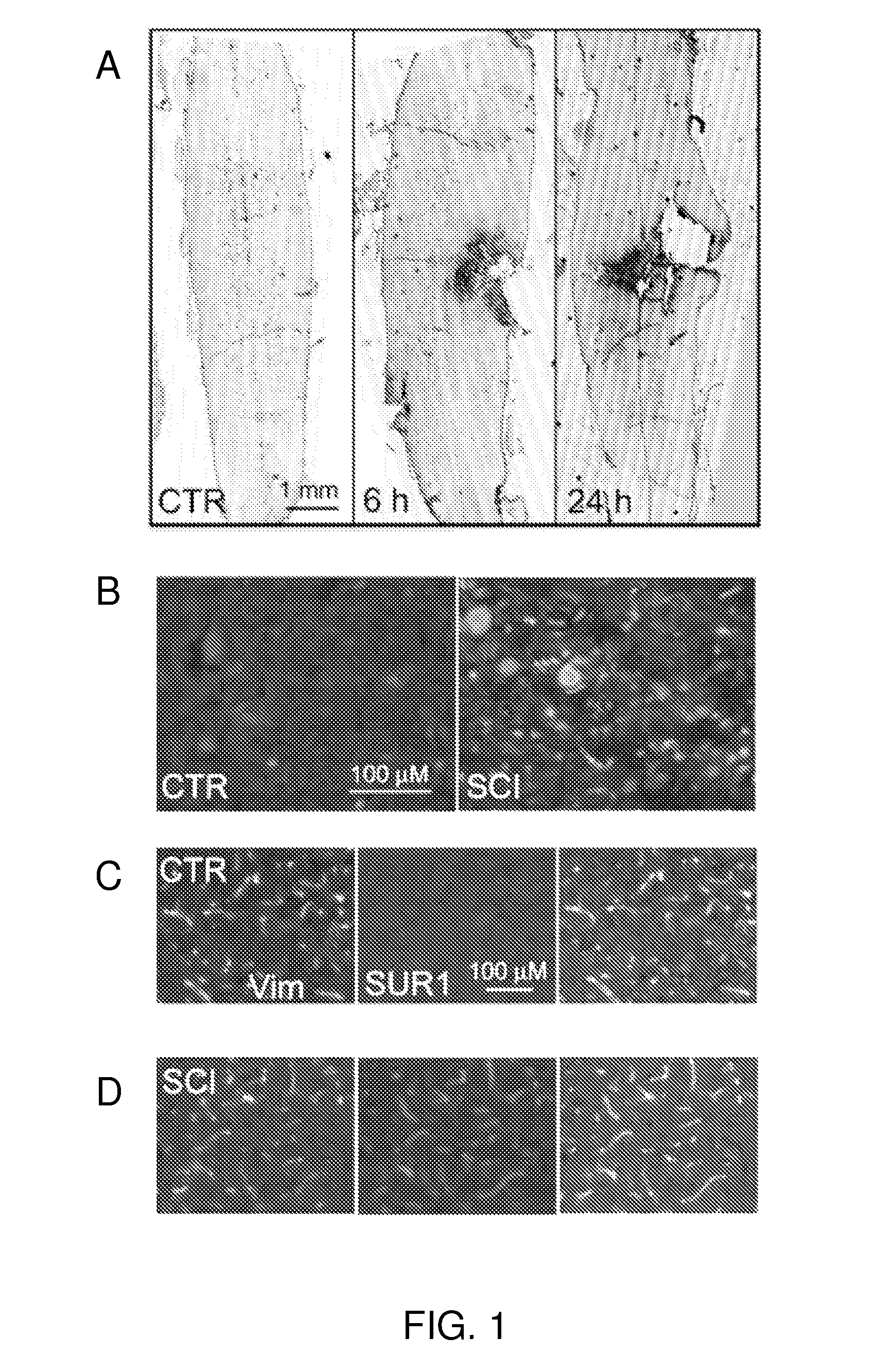 Inhibitors of NC<sub>Ca-ATP </sub>channels for therapy