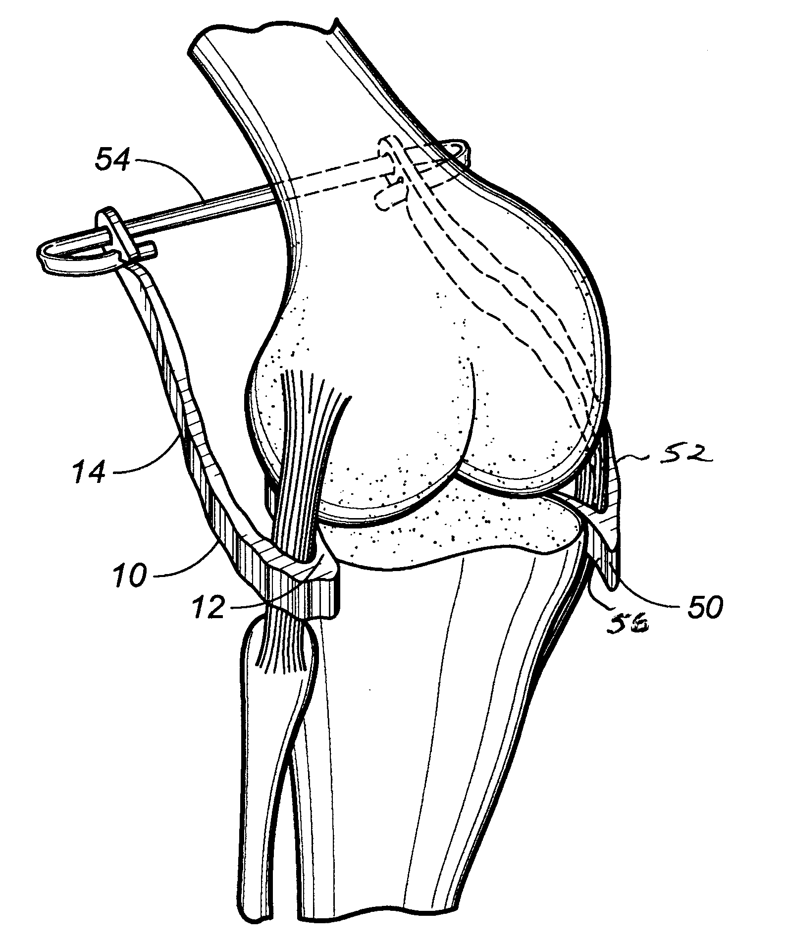 Ligament retractor assembly for use in performing knee surgery