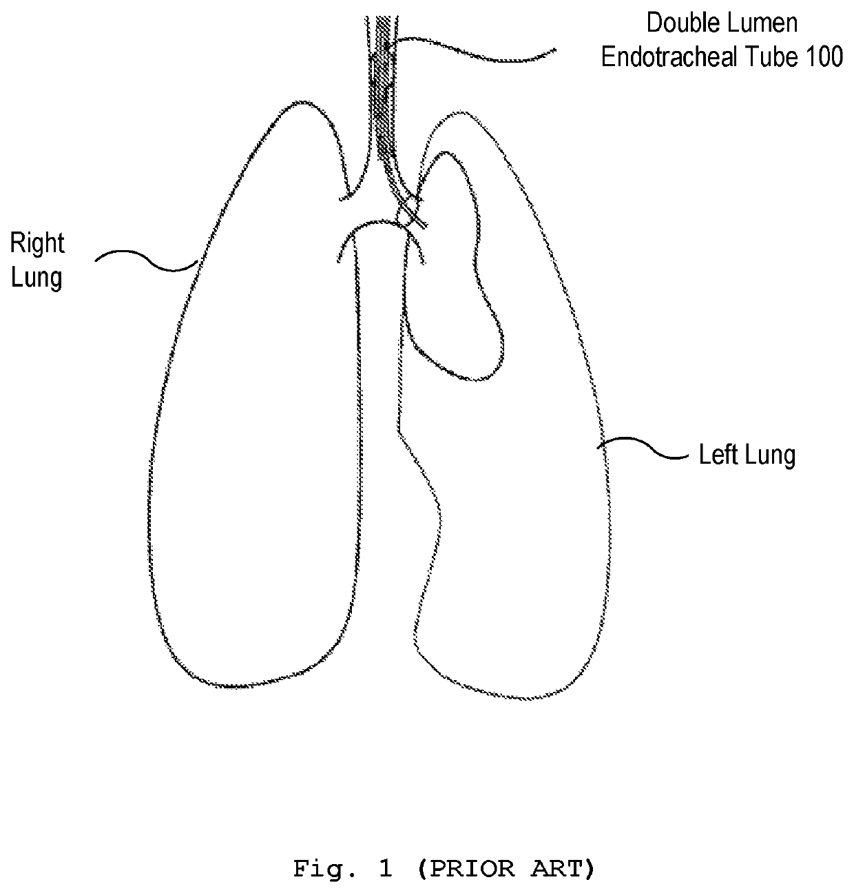 Double lumen tube capable of fixing trachea carina