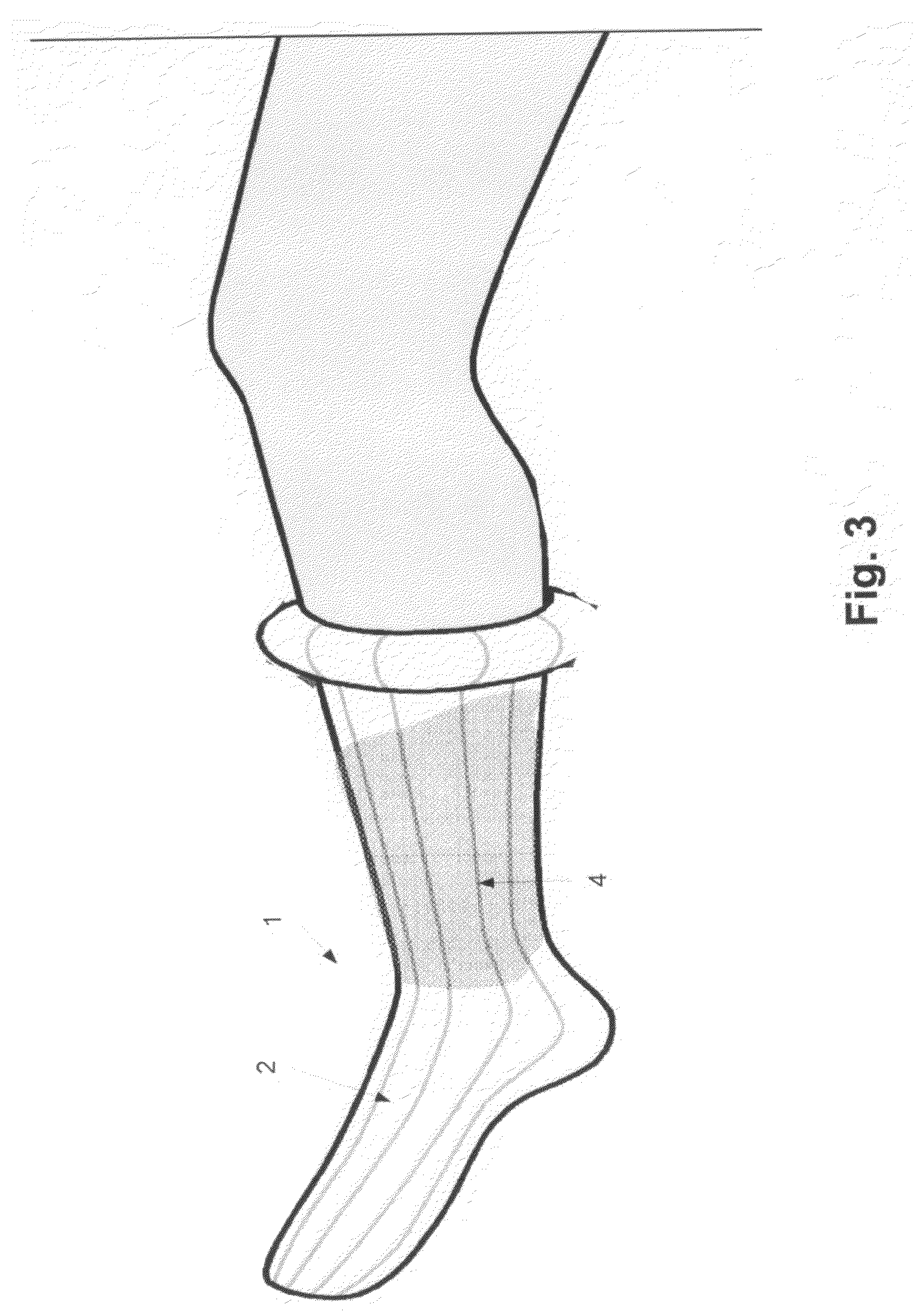 Medical device and a method for applying a biochemically active material on one or more body parts