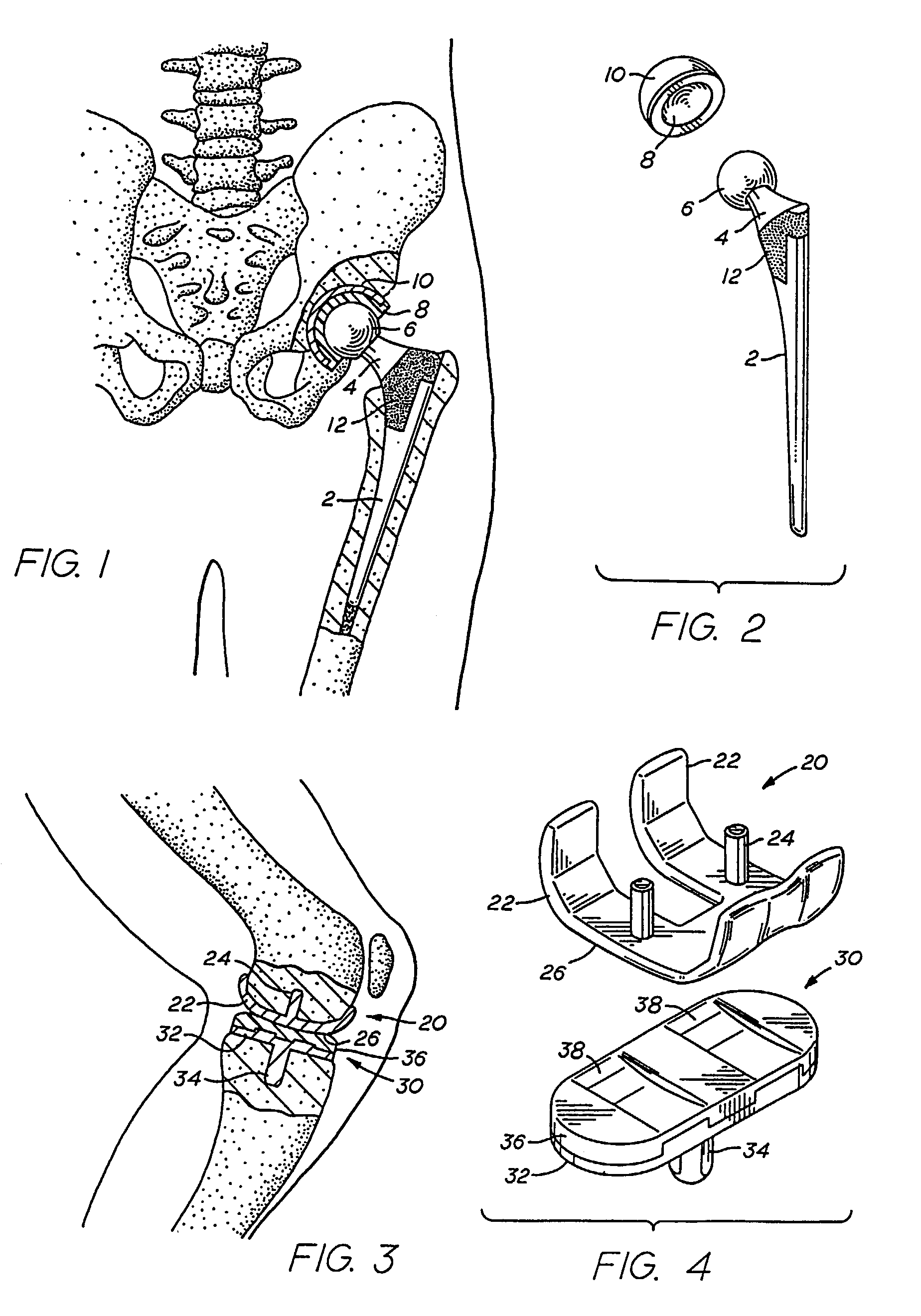 In-situ oxidized textured surfaces for prosthetic devices and method of making same