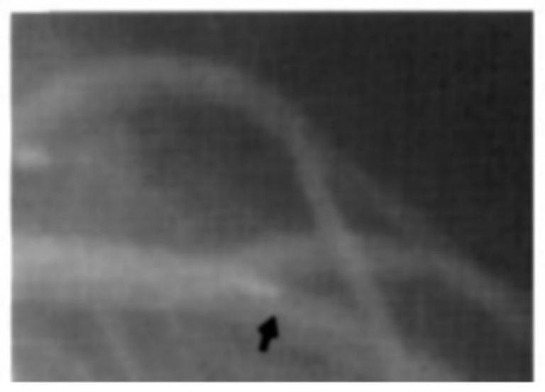 Artery intracavity image reconstruction method, device and equipment and storage medium