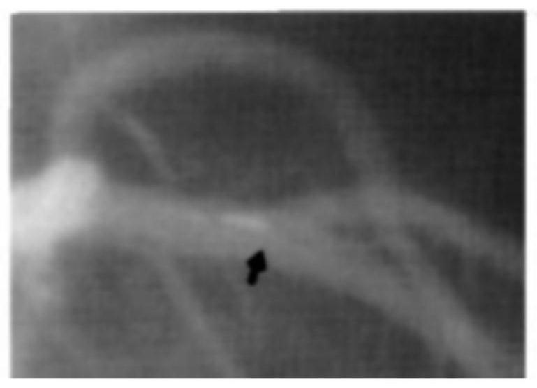 Artery intracavity image reconstruction method, device and equipment and storage medium