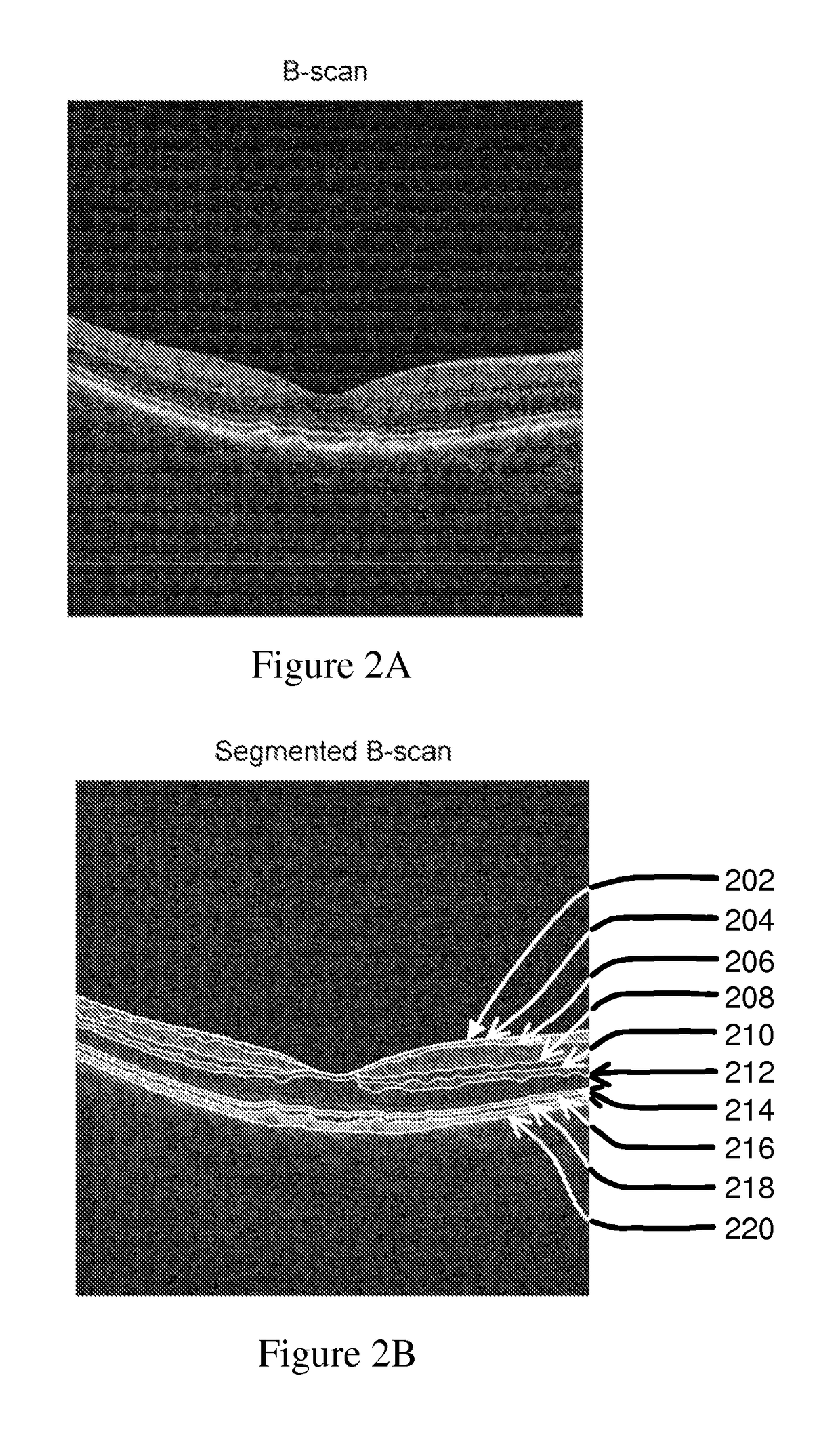 Method and system for evaluating progression of age-related macular degeneration