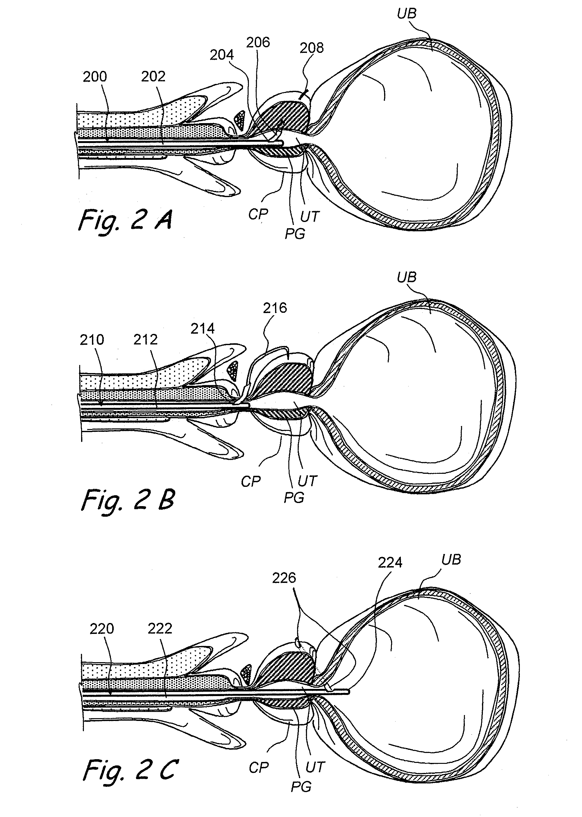 Devices, systems and methods for treating benign prostatic hyperplasia and other conditions