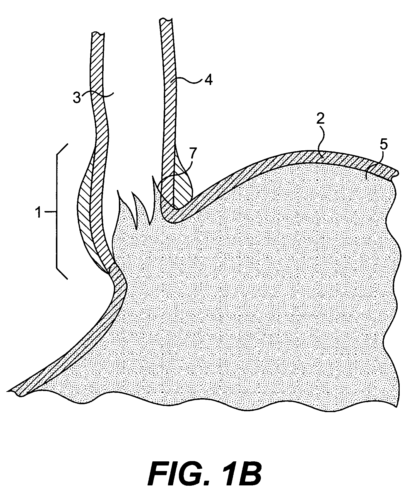 Tissue patches and related delivery systems and methods