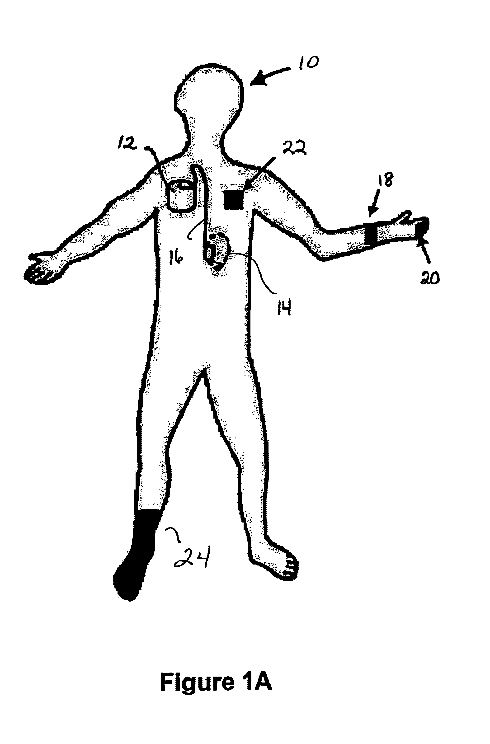 Implantable medical device controlled by a non-invasive physiological data measurement device