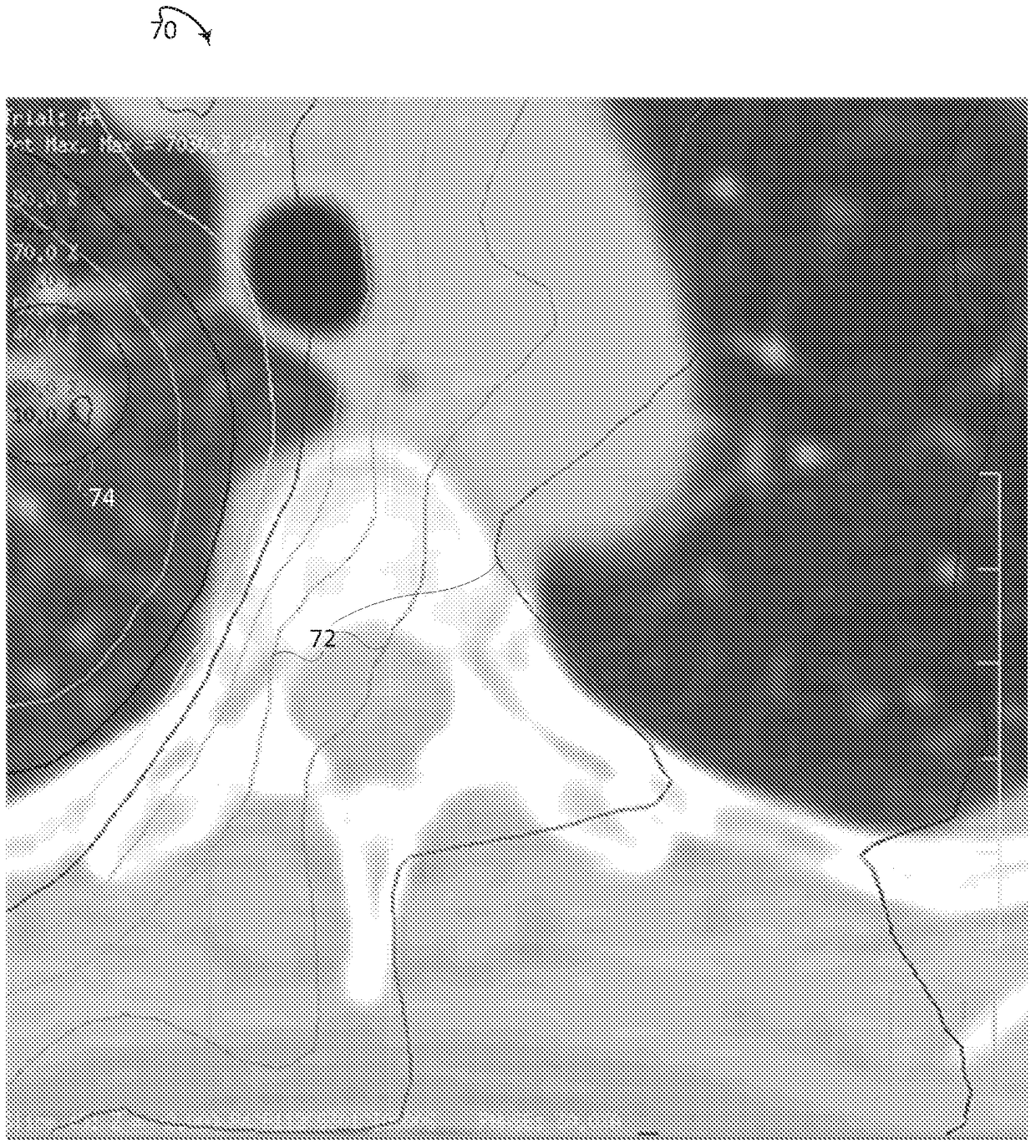 isodose optimization