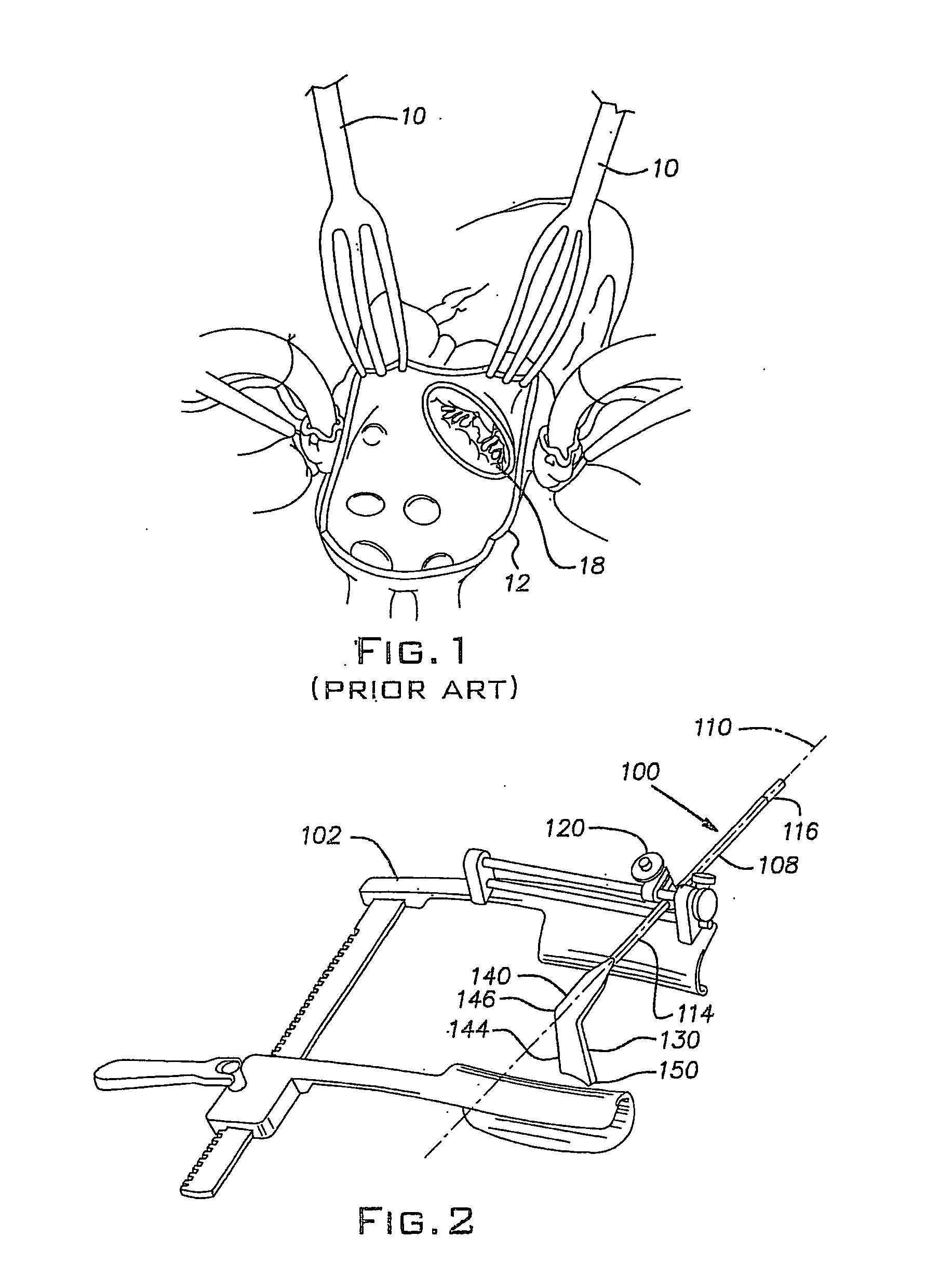 Sugical retractors and method of operation