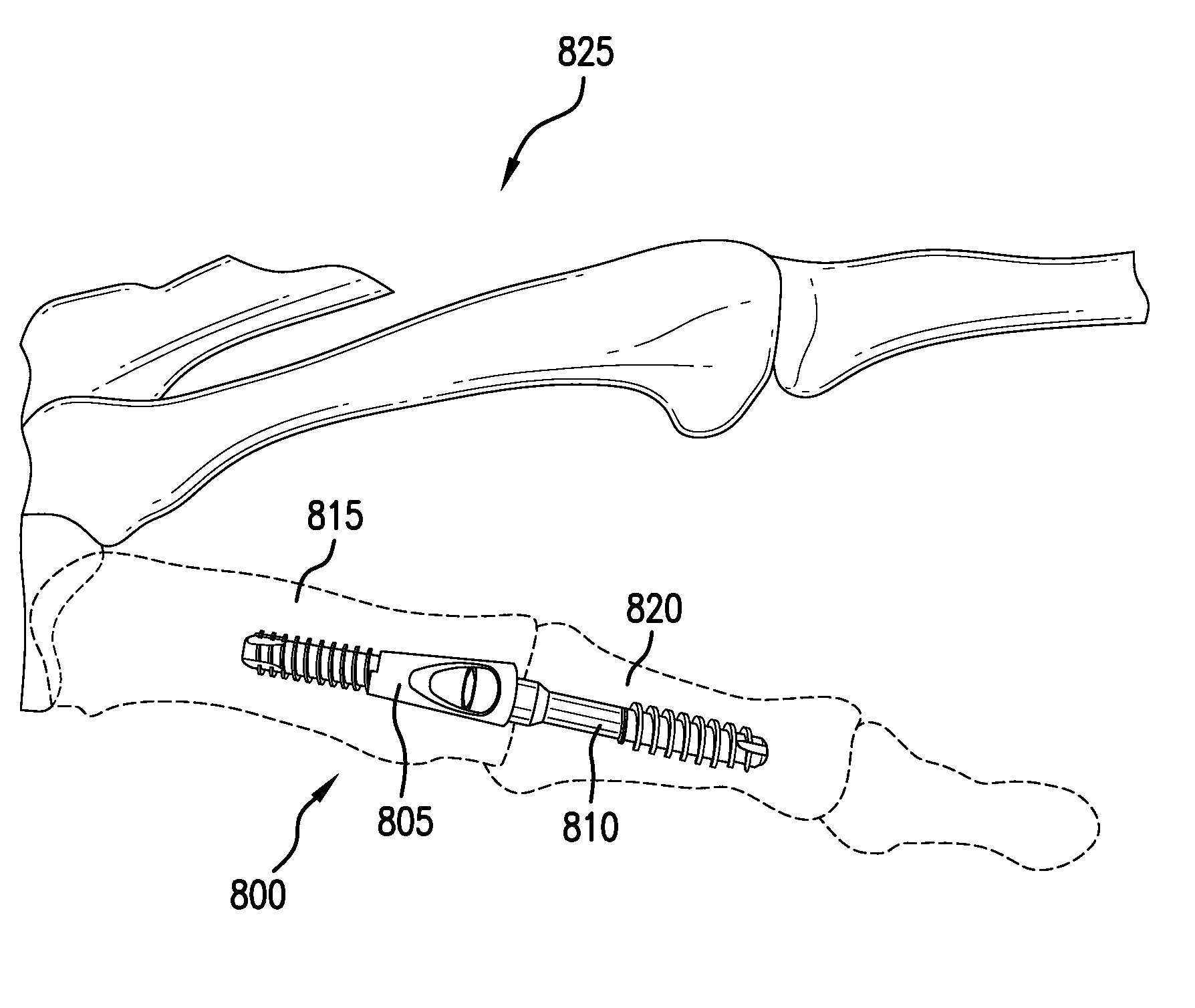 Intramedullary fixation assembly and method of use