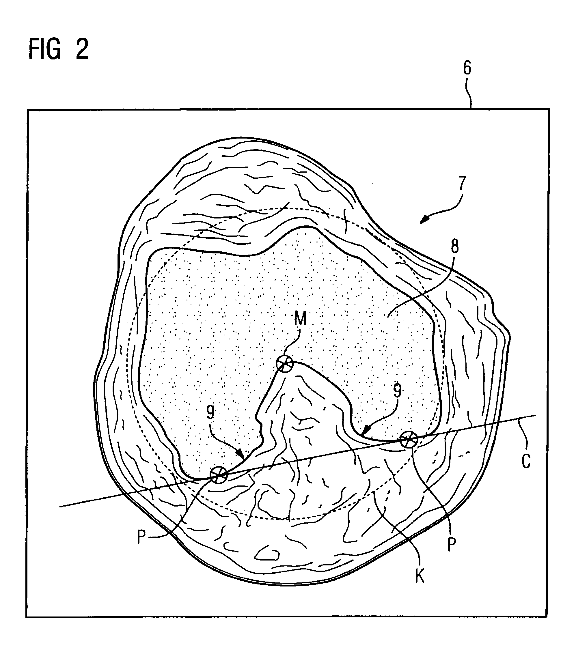 Mr method and apparatus for determining coronal and sagittal image planes from an image data set of a knee joint