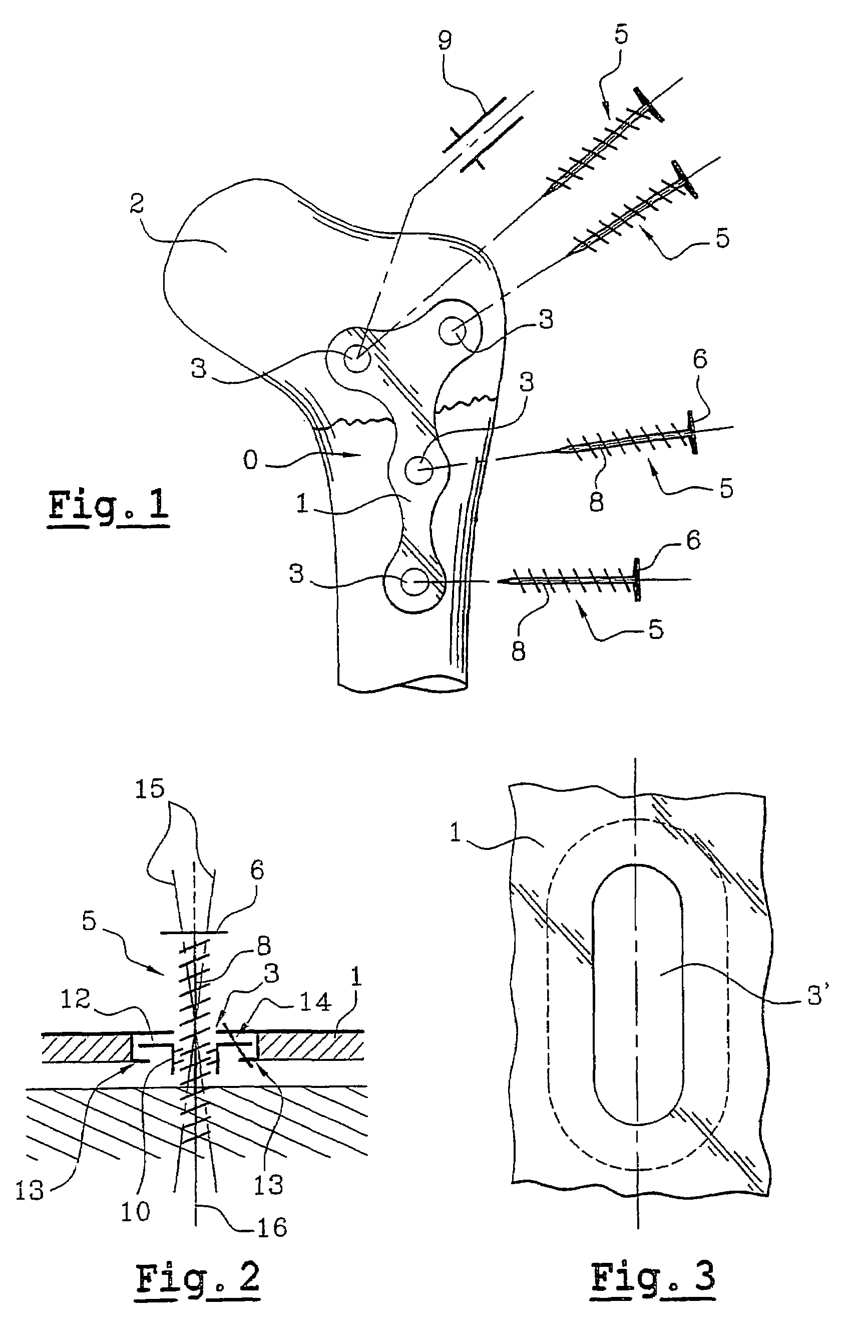 Orthopedic implant consisting of a support structure provided with at least an orifice for passing through a fixing screw associated with a nut