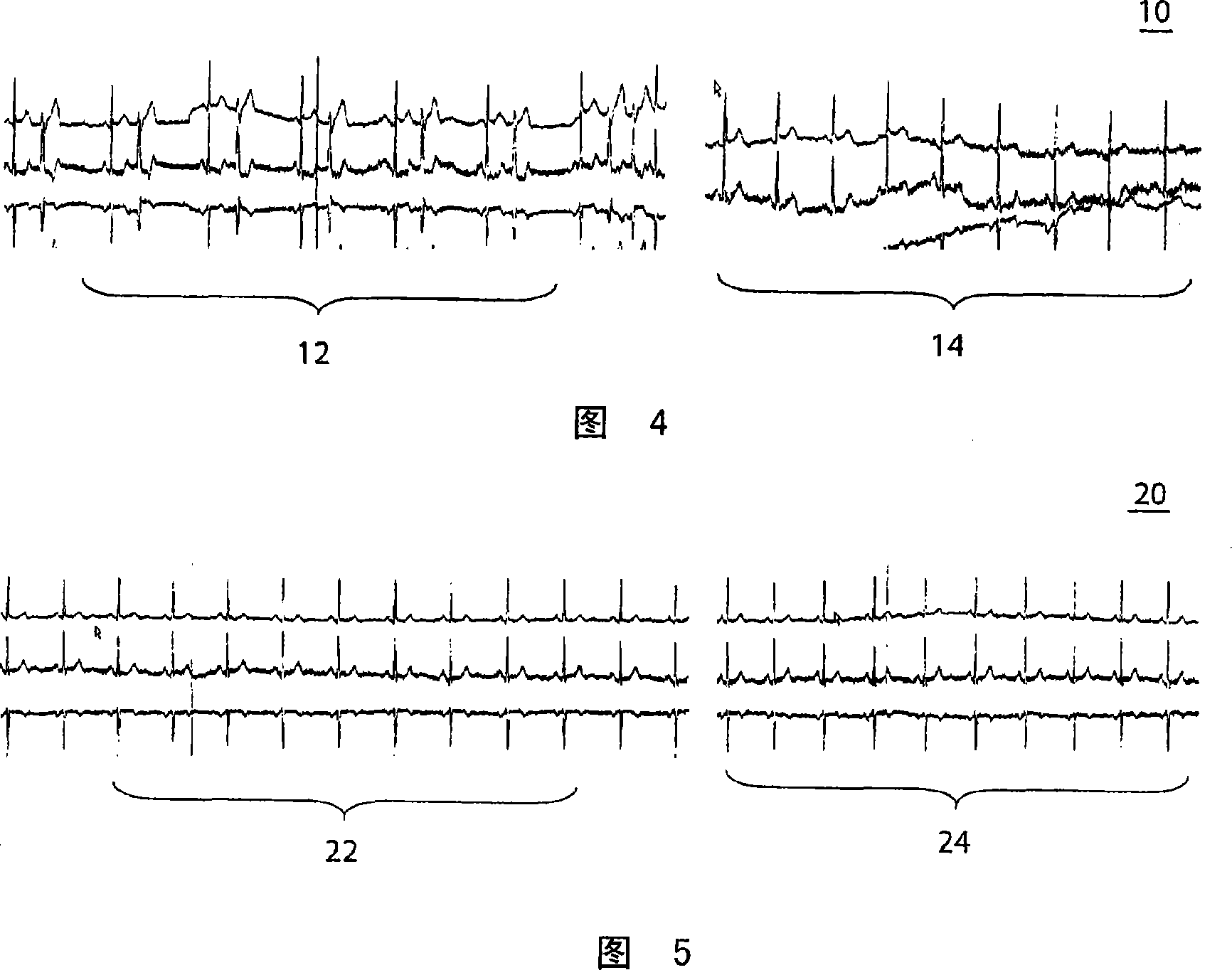 Pre-conditioned ECG system and method