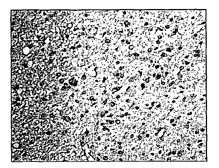 Methods for diagnosing and treating astrocytomas