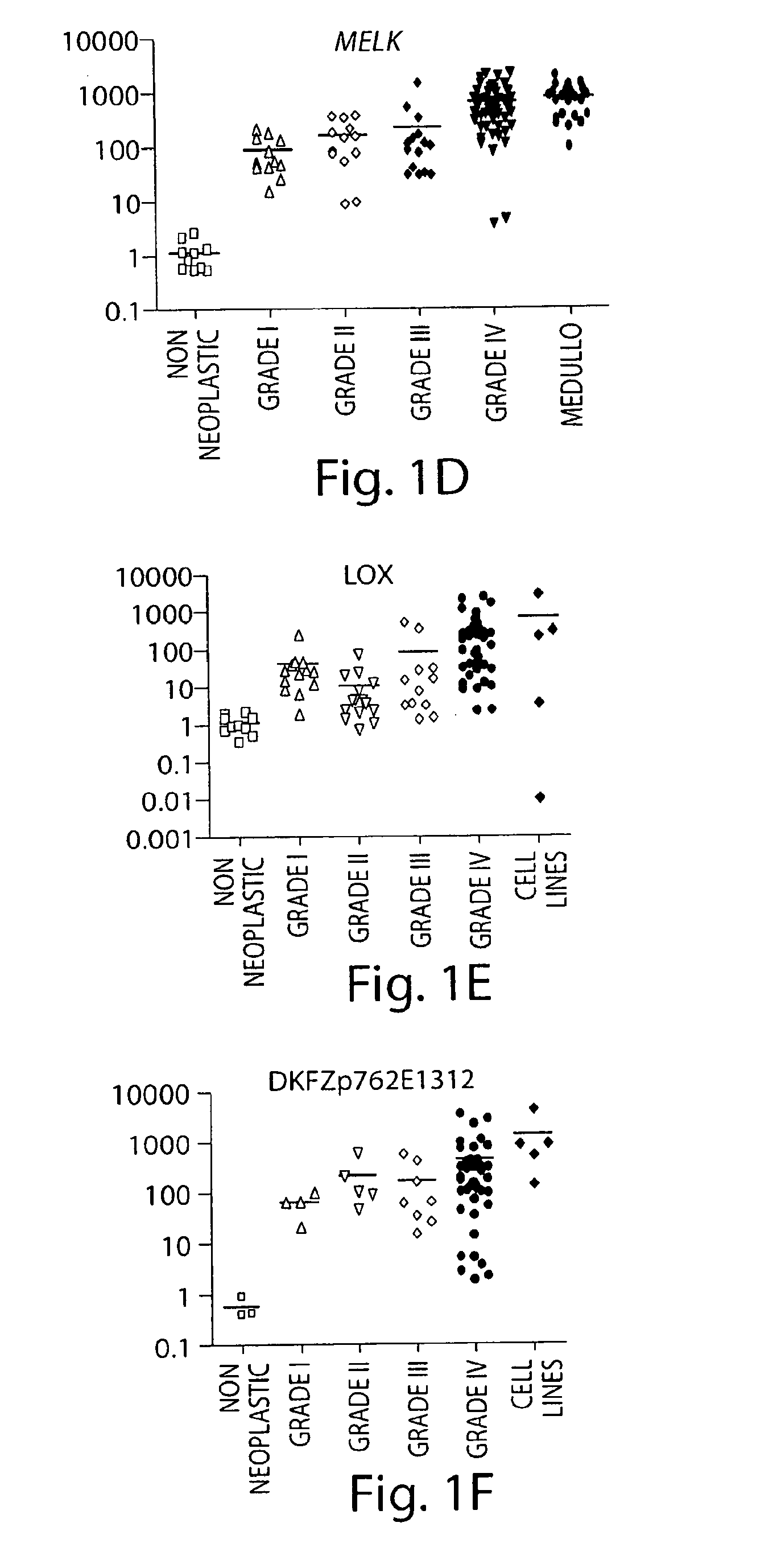 Methods for diagnosing and treating astrocytomas