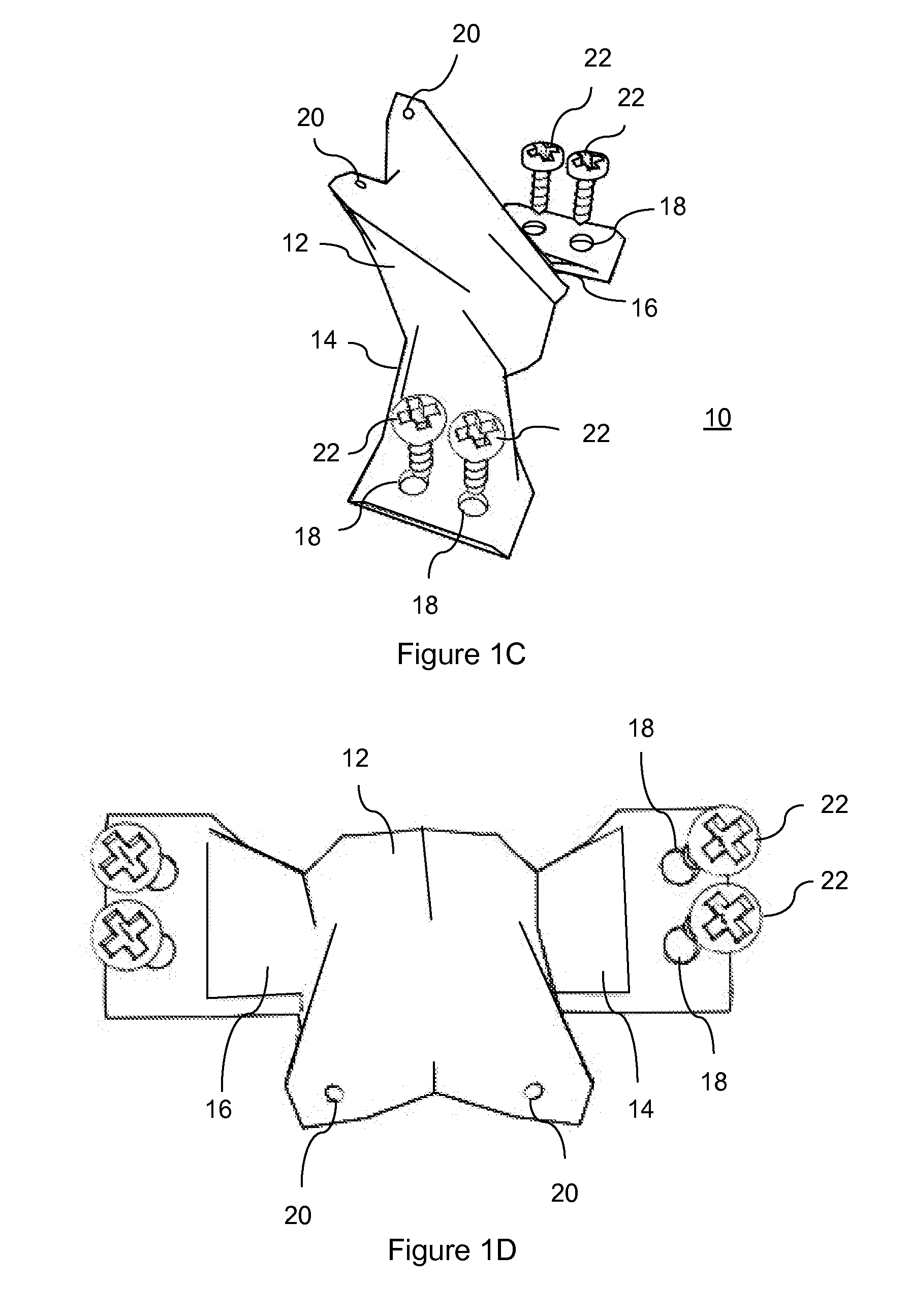 Total artificial spino-laminar prosthetic replacement