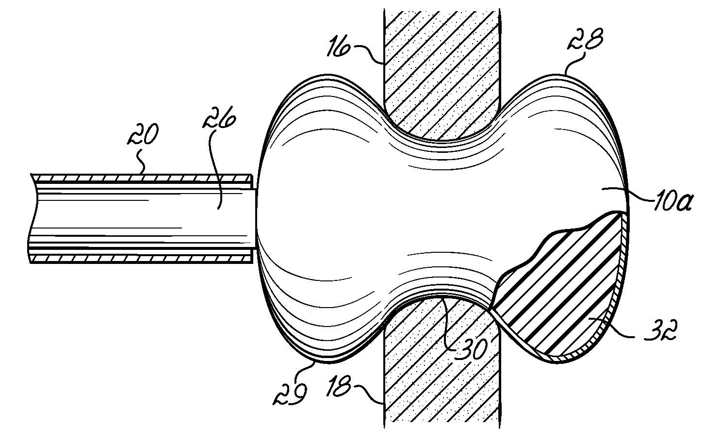 In-situ curable interspinous process spacer